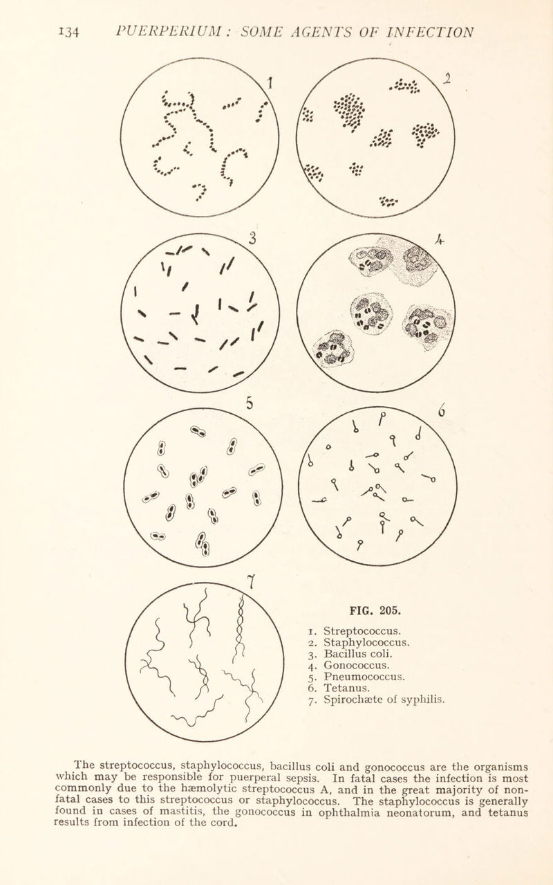 FIG. 205. 1. Streptococcus. 2. Staphylococcus. 3. Bacillus coli. 4. Gonococcus. 5. Pneumococcus. 6. Tetanus. 7. Spirochaete of syphilis. Ihe streptococcus, staphylococcus, bacillus coli and gonococcus are the organisms which may be responsible for puerperal sepsis. In fatal cases the infection is most commonly due to the haemolytic streptococcus A, and in the great majority of non- fatal cases to this streptococcus or staphylococcus. The staphylococcus is generally found in cases of mastitis, the gonococcus in ophthalmia neonatorum, and tetanus results from infection of the cord.