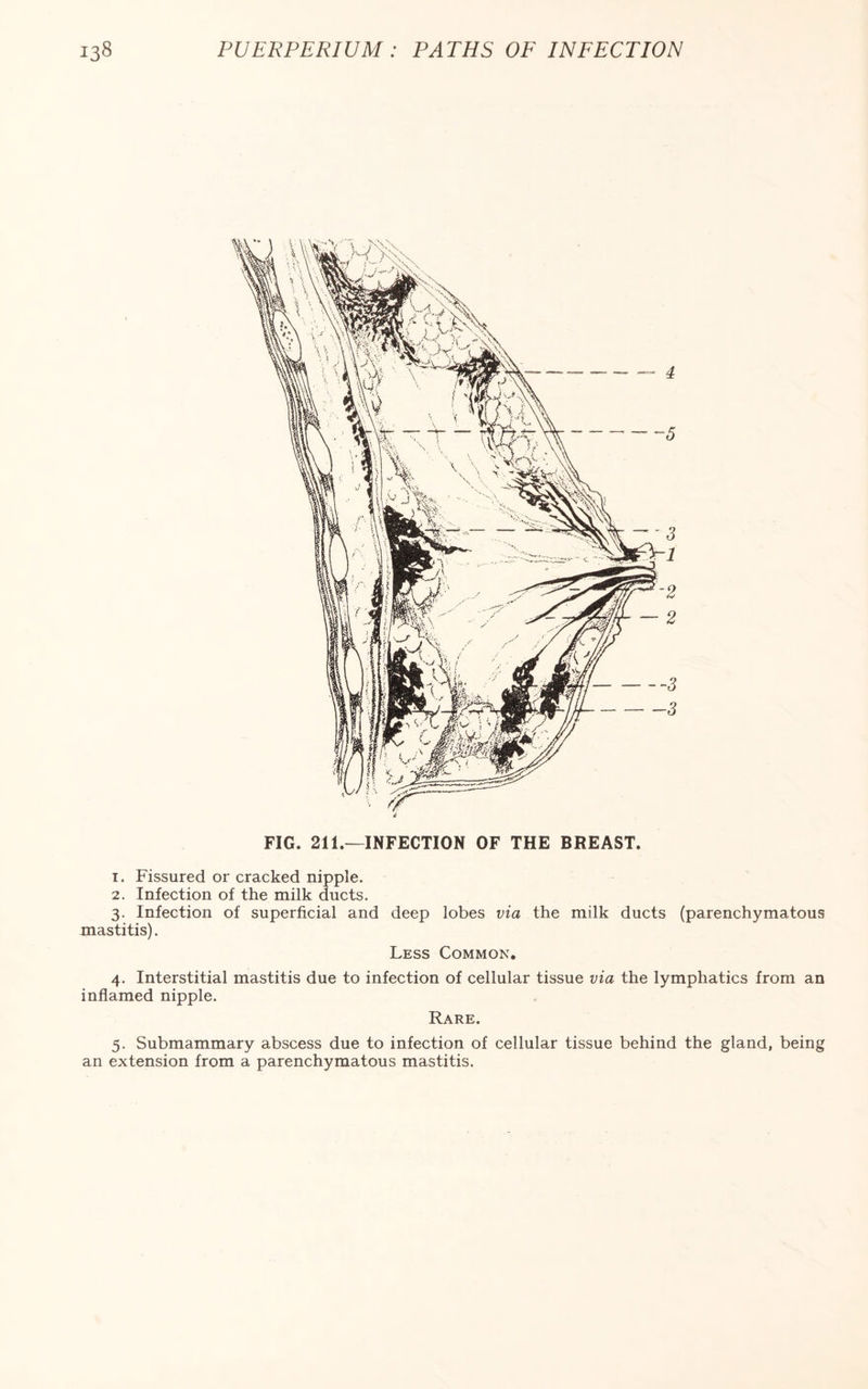 FIG. 211.—INFECTION OF THE BREAST. 1. Fissured or cracked nipple. 2. Infection of the milk ducts. 3. Infection of superficial and deep lobes via the milk ducts (parenchymatous mastitis). Less Common. 4. Interstitial mastitis due to infection of cellular tissue via the lymphatics from an inflamed nipple. Rare. 5. Submammary abscess due to infection of cellular tissue behind the gland, being an extension from a parenchymatous mastitis.