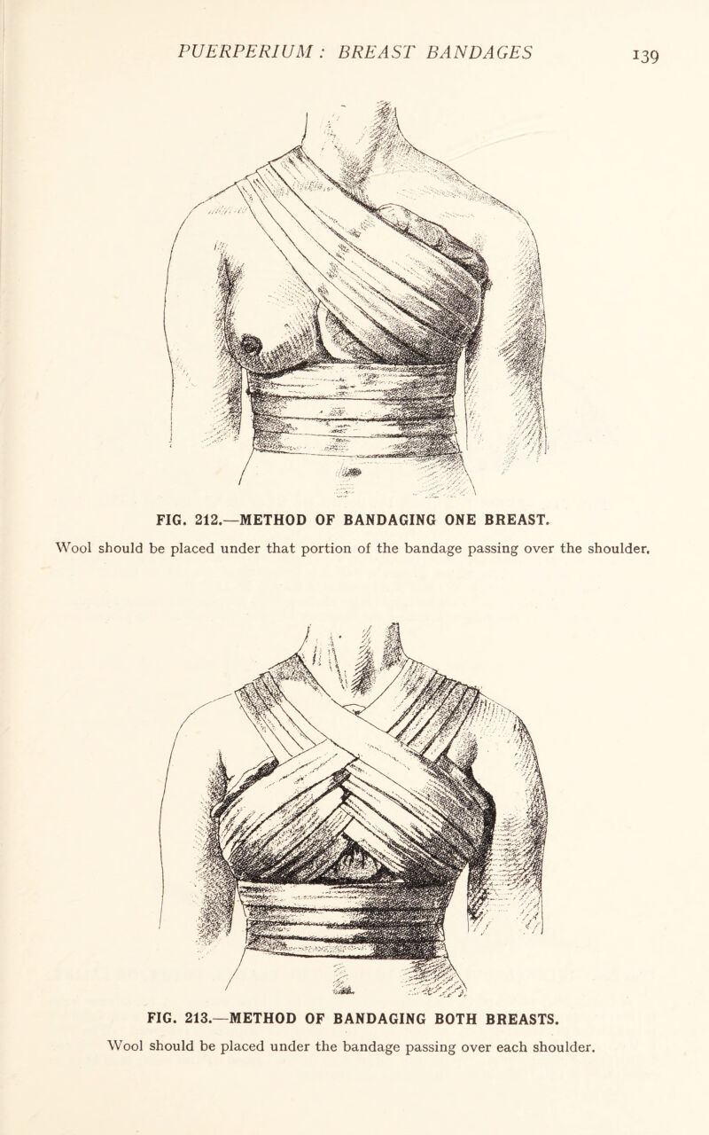 PUERPERIUM : BREAST BANDAGES FIG. 212.—METHOD OF BANDAGING ONE BREAST. Wool should be placed under that portion of the bandage passing over the shoulder. FIG. 213.—METHOD OF BANDAGING BOTH BREASTS. Wool should be placed under the bandage passing over each shoulder