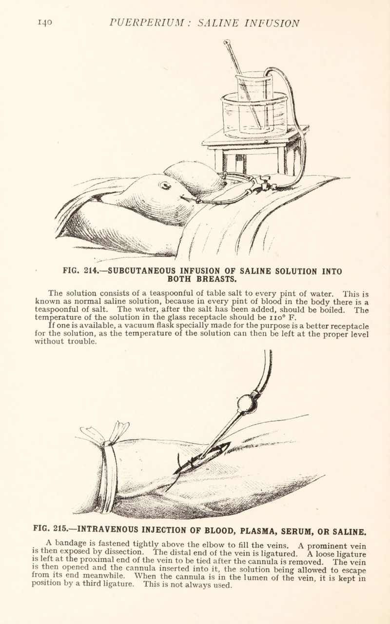 FIG. 214.—SUBCUTANEOUS INFUSION OF SALINE SOLUTION INTO BOTH BREASTS. The solution consists of a teaspoonful of table salt to every pint of water. This is known as normal saline solution, because in every pint of blood in the body there is a teaspoonful of salt. The water, after the salt has been added, should be boiled. The temperature of the solution in the glass receptacle should be no0 F. If one is available, a vacuum flask specially made for the purpose is a better receptacle for the solution, as the temperature of the solution can then be left at the proper level without trouble. FIG. 215.—INTRAVENOUS INJECTION OF BLOOD, PLASMA, SERUM, OR SALINE. . bandage is fastened tightly above the elbow to fill the veins. A prominent vein is then exposed by dissection. The distal end of the vein is ligatured. A loose ligature is left at the proximal end of the vein to be tied after the cannula is removed. The vein is then opened and the cannula inserted into it, the solution being allowed to escape from its end meanwhile. When the cannula is in the lumen of the vein, it is kept in position by a third ligature. This is not always used.