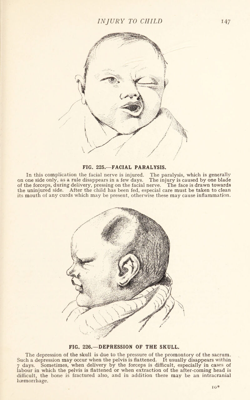 FIG. 225^—FACIAL PARALYSIS. In this complication the facial nerve is injured. The paralysis, which is generally on one side only, as a rule disappears in a few days. The injury is caused by one blade of the forceps, during delivery, pressing on the facial nerve. The face is drawn towards the uninjured side. After the child has been fed, especial care must be taken to clean its mouth of any curds which may be present, otherwise these may cause inflammation. FIG. 226.—DEPRESSION OF THE SKULL. The depression of the skull is due to the pressure of the promontory of the sacrum. Such a depression may occur when the pelvis is flattened. It usually disappears within 7 days. Sometimes, when delivery by the forceps is difficult, especially in cases of labour in which the pelvis is flattened or when extraction of the after-coming head is difficult, the bone is fractured also, and in addition there may be an intracranial haemorrhage.