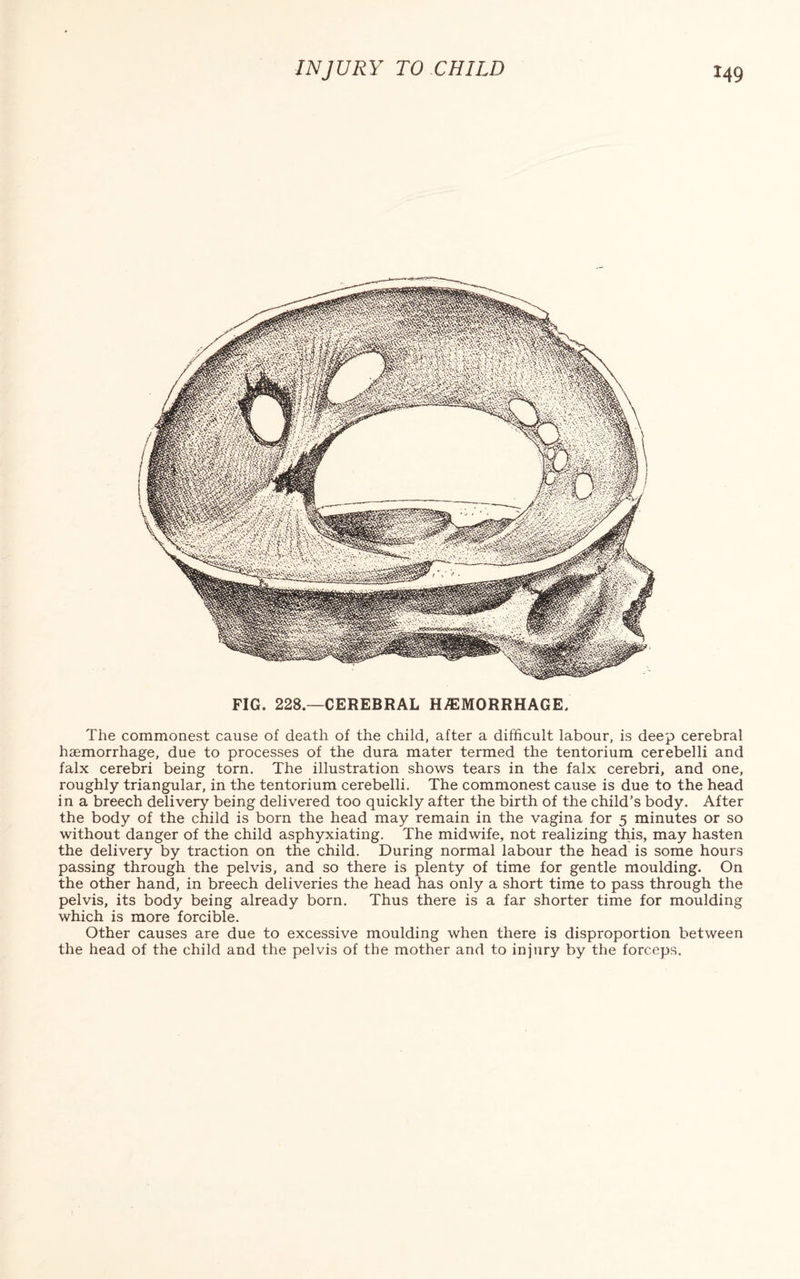 FIG. 228.—CEREBRAL HEMORRHAGE. The commonest cause of death of the child, after a difficult labour, is deep cerebral haemorrhage, due to processes of the dura mater termed the tentorium cerebelli and falx cerebri being torn. The illustration shows tears in the falx cerebri, and one, roughly triangular, in the tentorium cerebelli. The commonest cause is due to the head in a breech delivery being delivered too quickly after the birth of the child’s body. After the body of the child is born the head may remain in the vagina for 5 minutes or so without danger of the child asphyxiating. The midwife, not realizing this, may hasten the delivery by traction on the child. During normal labour the head is some hours passing through the pelvis, and so there is plenty of time for gentle moulding. On the other hand, in breech deliveries the head has only a short time to pass through the pelvis, its body being already born. Thus there is a far shorter time for moulding which is more forcible. Other causes are due to excessive moulding when there is disproportion between the head of the child and the pelvis of the mother and to injury by the forceps.