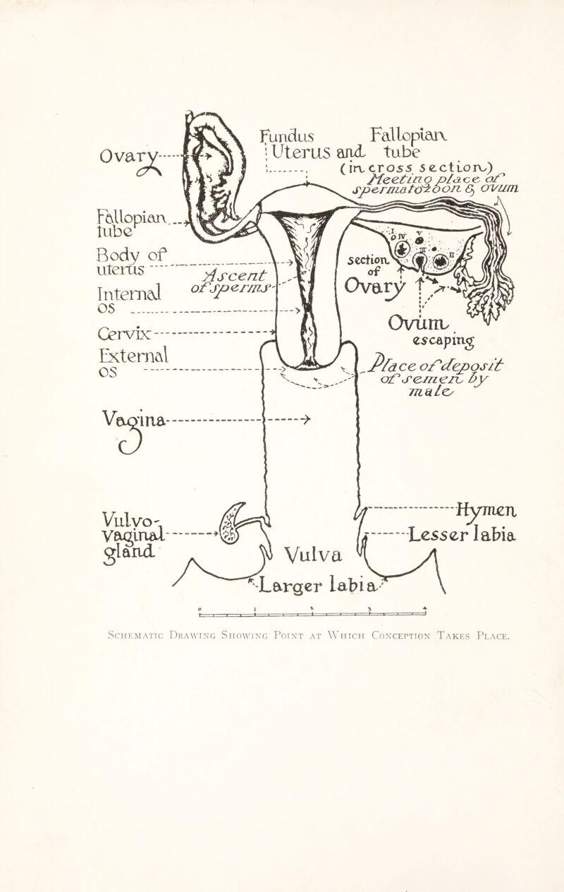 Ovar Fundus Fallopian. Uterus and. tube (irvcros5 sectLoru) Meetlno plaoe of spermatozoon. <5> oi/uni OQ'l XJ Tllopian ::ubu Body of uterus.fscent Internal ofsperms OS OrvEc External os Vaoitta Ovimv escaping ffdce of deposit of seme ru by m^Leo Vulvo¬ vaginal gland. Hynien -Lesser labia Vulva Larger labia; Schematic Drawing Showing Point at Which Conception Takes Place.