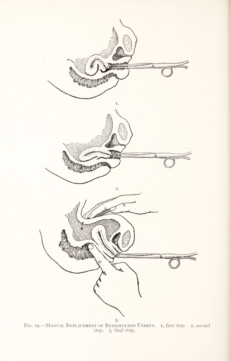 Fig. 19 1. .—Manual Replacement of Retroflexed Uterus, i, first step. 2, second step. 3, final step.