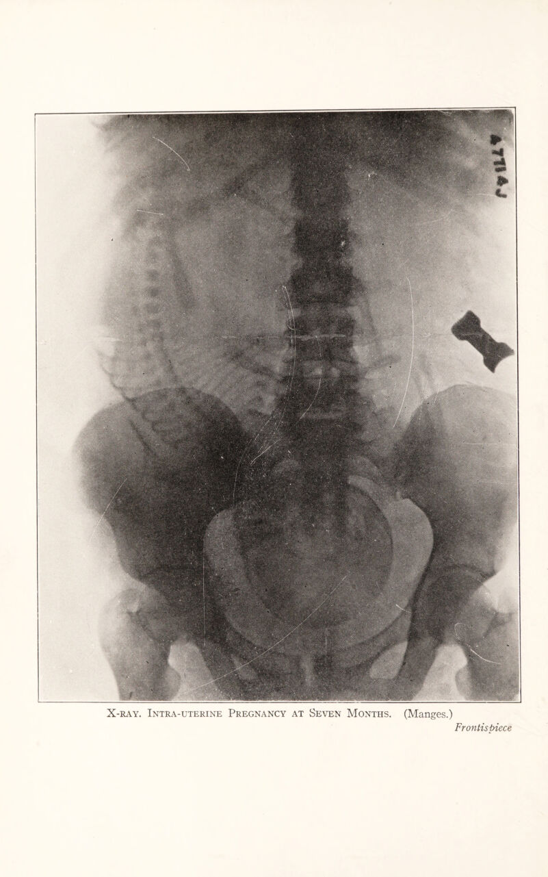 X-RAY. INTRA-UTERINE PREGNANCY AT SEVEN MONTHS. (Manges.) Frontispiece
