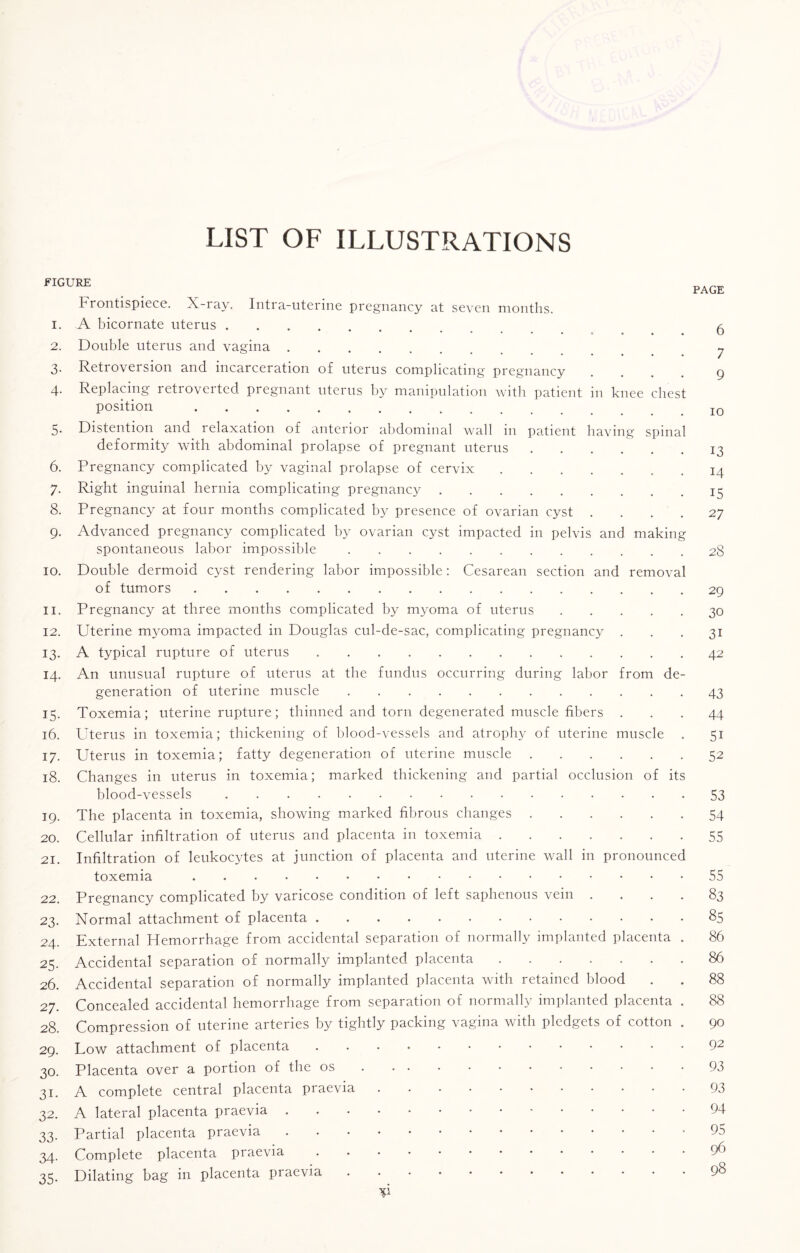 LIST OF ILLUSTRATIONS fICUE£ . . PAGE Frontispiece. X-ray. Intra-uterine pregnancy at seven months. 1. A bicornate uterus. ^ 2. Double uterus and vagina ... n 3. Retroversion and incarceration of uterus complicating pregnancy .... 9 4. Replacing retroverted pregnant uterus by manipulation with patient in knee chest position .. 5. Distention and relaxation of anterior abdominal wall in patient having spinal deformity with abdominal prolapse of pregnant uterus . . . . . 13 6. Pregnancy complicated by vaginal prolapse of cervix.. . 14 7. Right inguinal hernia complicating pregnancy.15 8. Pregnancy at four months complicated by presence of ovarian cyst .... 27 9. Advanced pregnancy complicated by ovarian cyst impacted in pelvis and making spontaneous labor impossible.28 10. Double dermoid cyst rendering labor impossible: Cesarean section and removal of tumors.29 11. Pregnancy at three months complicated by myoma of uterus.30 12. Uterine myoma impacted in Douglas cul-de-sac, complicating pregnancy ... 31 13. A typical rupture of uterus ..42 14. An unusual rupture of uterus at the fundus occurring during labor from de¬ generation of uterine muscle.43 15. Toxemia; uterine rupture; thinned and torn degenerated muscle fibers ... 44 16. Uterus in toxemia; thickening of blood-vessels and atrophy of uterine muscle . 51 17. Uterus in toxemia; fatty degeneration of uterine muscle.52 18. Changes in uterus in toxemia; marked thickening and partial occlusion of its blood-vessels.53 19. The placenta in toxemia, showing marked fibrous changes.54 20. Cellular infiltration of uterus and placenta in toxemia.55 21. Infiltration of leukocytes at junction of placenta and uterine wall in pronounced toxemia .55 22. Pregnancy complicated by varicose condition of left saphenous vein .... 83 23. Normal attachment of placenta.85 24. External Hemorrhage from accidental separation of normally implanted placenta . 86 25. Accidental separation of normally implanted placenta.86 26. Accidental separation of normally implanted placenta with retained blood . . 88 27. Concealed accidental hemorrhage from separation of normally implanted placenta . 88 28. Compression of uterine arteries by tightly packing vagina with pledgets of cotton . 90 29. Low attachment of placenta.92 30. Placenta over a portion of the os. 93 31. A complete central placenta praevia.93 32. A lateral placenta praevia.94 33. Partial placenta praevia 95 34. Complete placenta praevia.9^ 35. Dilating bag in placenta praevia.9§ P