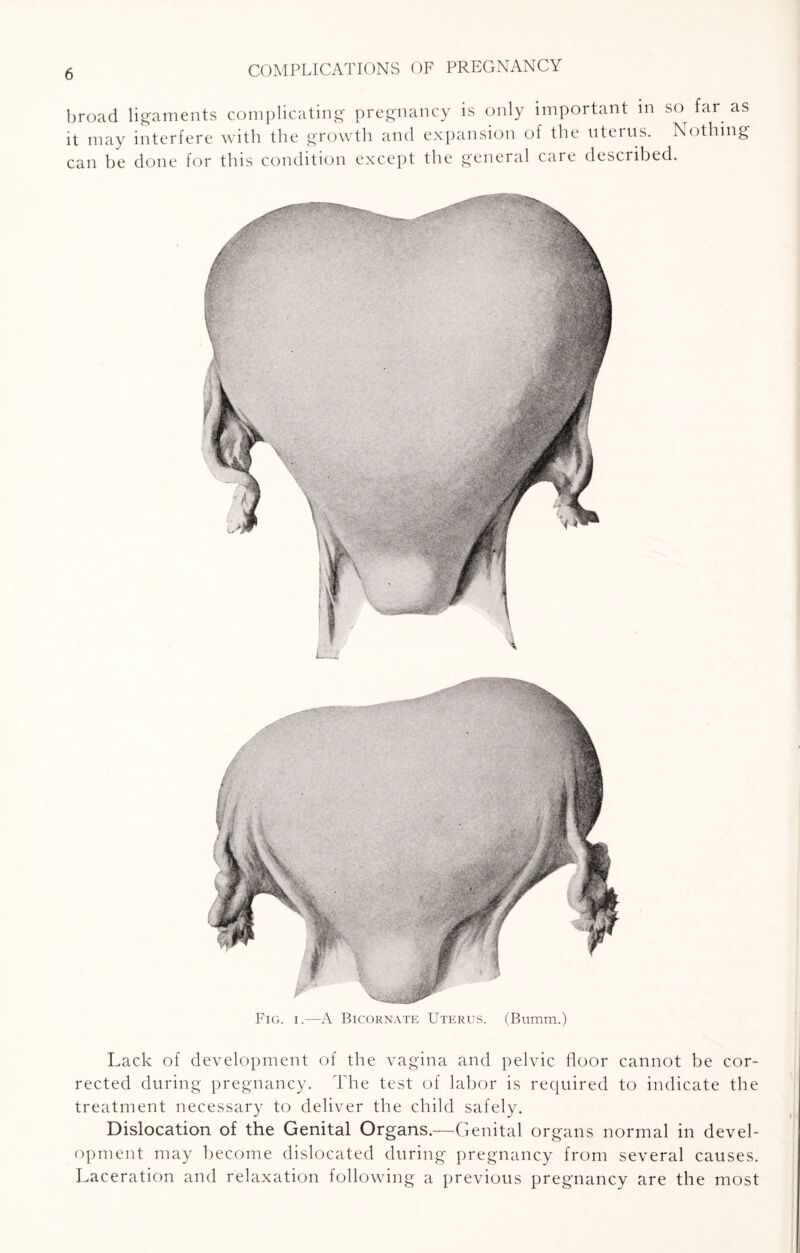 broad ligaments complicating pregnancy is only important in so^ far as it may interfere with the growth and expansion of the uterus. Nothing can be done for this condition except the general care described. Fig. i.—A Bicornate Uterus. (Bumm.) Lack of development of the vagina and pelvic floor cannot be cor¬ rected during pregnancy. The test of labor is required to indicate the treatment necessary to deliver the child safely. Dislocation of the Genital Organs.—Genital organs normal in devel¬ opment may become dislocated during pregnancy from several causes. Laceration and relaxation following a previous pregnancy are the most