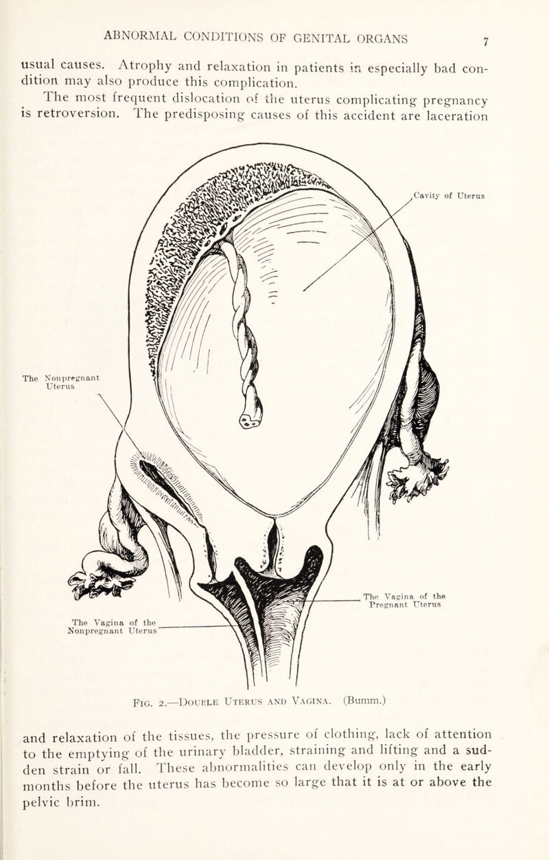 usual causes. Atrophy and relaxation in patients in especially bad con¬ dition may also produce this complication. The most frequent dislocation of the uterus complicating pregnancy is retroversion. the predisposing causes of this accident are laceration and relaxation of the tissues, the pressure of clothing, lack of attention to the emptying of the urinary bladder, straining and lifting and a sud¬ den strain or fall. These abnormalities can develop only in the early months before the uterus has become so large that it is at or above the pelvic brim.