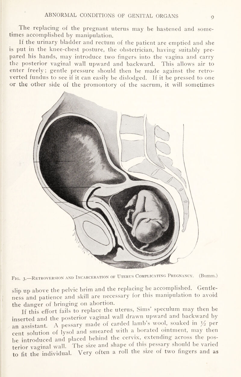 pIG 3_Retroversion and Incarceration of Uterus Complicating Pregnancy. (Bumm.) slip up above the pelvic brim and the replacing be accomplished. Gentle¬ ness and patience and skill are necessary for this manipulation to avoid the danger of bringing on abortion. If this effort fails to replace the uterus, Sims’ speculum may then be inserted and the posterior vaginal wall drawn upward and backward by an assistant. A pessary made of carded lamb’s wool, soaked in y2 per cent solution of lysol and smeared with a borated ointment, may then be introduced and placed behind the cervix, extending across the pos¬ terior vaginal wall. The size and shape of this pessary should be varied to fit the individual. Very often a roll the size of two fingers and as ABNORMAL CONDITIONS OF GENITAL ORGANS The replacing- of the pregnant uterus may be hastened and some¬ times accomplished by manipulation. If the urinary bladder and rectum of the patient are emptied and she is put in the knee-chest posture, the obstetrician, having suitably pre¬ pared his hands, may introduce two fingers into the vagina and carry the posterior vaginal wall upward and backward. This allows air to enter freely; gentle pressure should then be made against the retro- verted fundus to see if it can easily be dislodged. If it be pressed to one or the other side of the promontory of the sacrum, it will sometimes