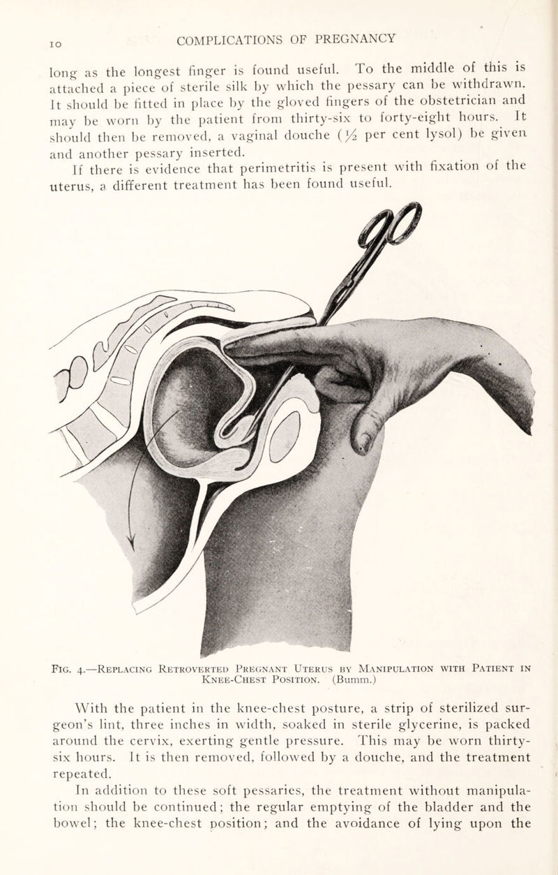 long as the longest finger is found useful. To the middle of this is attached a piece of sterile silk by which the pessary can be withdrawn. It should be fitted in place by the gloved fingers of the obstetrician and may be worn by the patient from thirty-six to forty-eight hours. It should then be removed, a vaginal douche (J4 per cent lysol) be given, and another pessary inserted. If there is evidence that perimetritis is present with fixation of the uterus, a different treatment has been found useful. Fig. 4.—Replacing Retroverted Pregnant Uterus by Manipulation with Patient in Knee-Chest Position. (Bumm.) With the patient in the knee-chest posture, a strip of sterilized sur¬ geon’s lint, three inches in width, soaked in sterile glycerine, is packed around the cervix, exerting gentle pressure. This may be worn thirty- six hours. It is then removed, followed by a douche, and the treatment repeated. In addition to these soft pessaries, the treatment without manipula¬ tion should be continued; the regular emptying of the bladder and the bowel; the knee-chest position; and the avoidance of lying upon the