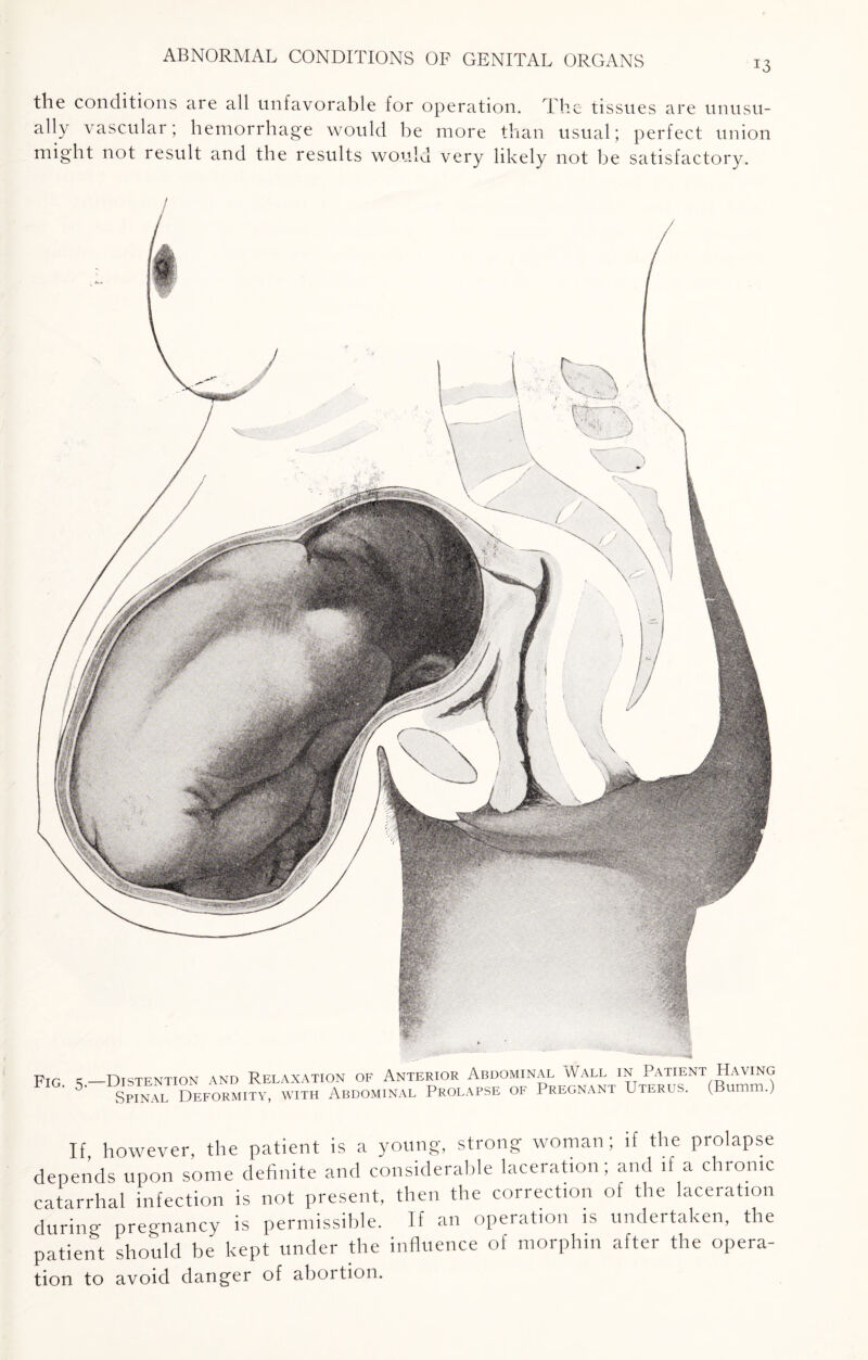 T3 the conditions are all unfavorable for operation. The tissues are unusu¬ ally vascular; hemorrhage would be more than usual; perfect union might not result and the results would very likely not be satisfactory. pIG c —Distention and Relaxation of Anterior Abdominal Wall in Patient Having 5' Spi™ Deformity, with Abdominal Prolapse of Pregnant Uterus. (Bumm.) If however, the patient is a young, strong woman; if the prolapse depends upon some definite and considerable laceration; and if a chronic catarrhal infection is not present, then the correction of the laceration during pregnancy is permissible. If an operation is undertaken, the patient should be kept under the influence of morphm after the opera- tion to avoid danger of abortion.