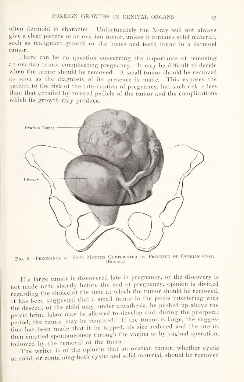 27 often dermoid in character. Unfortunately the X-ray will not always give a clear picture of an ovarian tumor, unless it contains solid material, such as malignant growth or the bones and teeth found in a dermoid tumor. I here can be no question concerning the importance of removing an ovarian tumor complicating pregnancy. It may be difficult to decide when the tumor should be removed. A small tumor should be removed as soon as the diagnosis of its presence is made. This exposes the patient to the risk of the interruption of pregnancy, but such risk is less than that entailed by twisted pedicle of the tumor and the complications which its growth may produce. Fig 8_Pregnancy at Four Months Complicated by Presence of Ovarian Cyst. (Bumm.) If a large tumor is discovered late in pregnancy, or the discovery is not made until shortly before the end of pregnancy, opinion is divided regarding the choice of the time at which the tumor should be removed. Itkas been suggested that a small tumor in the pelvis interfering with the descent of the child may, under anesthesia, be pushed up above the pelvic brim, labor may be allowed to develop and, during the puerperal period the’tumor may be removed. If the tumor is large, the sugges¬ tion has been made that it be tapped, its size reduced and the uterus then emptied spontaneously through the vagina or by vaginal operation, followed by the removal of the tumor. . The writer is of the opinion that an ovarian tumor, whether cystic or solid, or containing both cystic and solid material, should be removed
