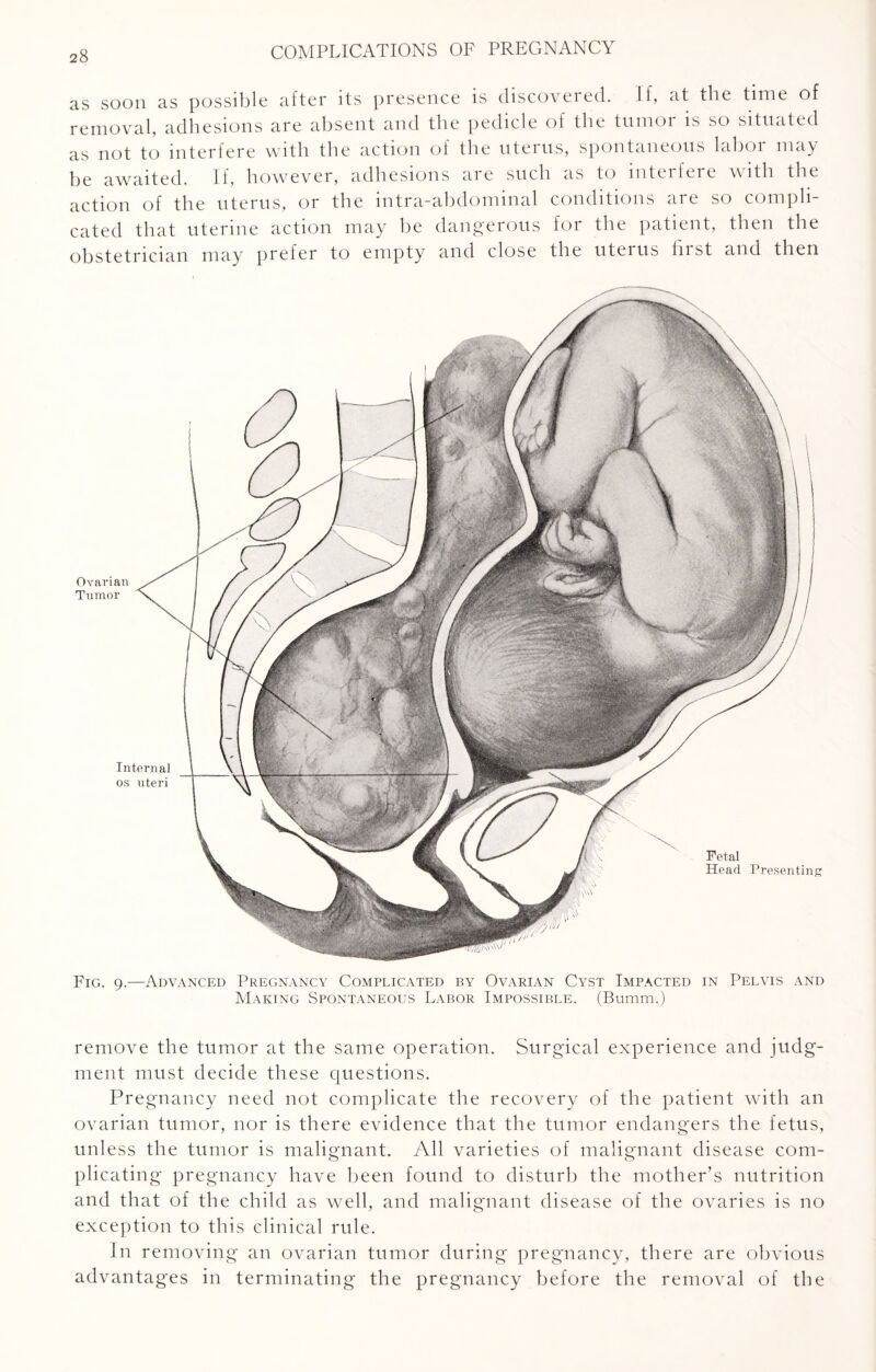 as soon as possible after its presence is discovered. If, at the time of removal, adhesions are absent and the pedicle of the tumor is so situated as not to interfere with the action of the uterus, spontaneous labor may be awaited. If, however, adhesions are such as to interfere with the action of the uterus, or the intra-abdominal conditions are so compli¬ cated that uterine action may be dangerous for the patient, then the obstetrician may prefer to empty and close the uterus lust and then Ovarian Tumor Internal os uteri Fetal Head Presenting Fig. 9.—Advanced Pregnancy Complicated by Ovarian Cyst Impacted in Pelvis and Making Spontaneous Labor Impossible. (Bumm.) remove the tumor at the same operation. Surgical experience and judg¬ ment must decide these questions. Pregnancy need not complicate the recovery of the patient with an ovarian tumor, nor is there evidence that the tumor endangers the fetus, unless the tumor is malignant. All varieties of malignant disease com¬ plicating pregnancy have been found to disturb the mother’s nutrition and that of the child as well, and malignant disease of the ovaries is no exception to this clinical rule. In removing an ovarian tumor during pregnancy, there are obvious advantages in terminating the pregnancy before the removal of the