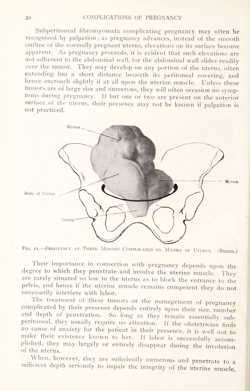 Subperitoneal fibromyomata complicating* pregnancy may often be recognized by palpation; as pregnancy advances, instead of the smooth outline of the normally pregnant uterus, elevations on its surface become apparent. As pregnancy proceeds, it is evident that such elevations are not adherent to the abdominal wall, for the abdominal wall slides readily over the tumor. They may develop on any portion of the uterus, often extending but a short distance beneath its peritoneal covering, and hence encroach slightly if at all upon the uterine muscle. Unless these tumors ai e ol large size and numerous, they will often occasion no symp¬ toms during pregnancy. If but one or two are present on the anterior surface of the uterus, their presence may not be known if palpation is not practiced. Fig. ii.—Pregnancy at Three Months Complicated by Myoma of Uterus (Bumm.) Their importance in connection with pregnancy depends upon the degree to which they penetrate and involve the uterine muscle. They are rarely situated so low in the uterus as to block the entrance to the pelvis, and hence if the uterine muscle remains competent they do not necessarily interfere with labor. 1 he treatment oi these tumors or the management of pregnancy complicated by their presence depends entirely upon their size, number and depth of penetration. So long as they remain essentially sub- peritoneal, they usually require no attention. Jf the obstetrician finds no cause of anxiety for the patient in their presence, it is well not to make their existence known to her. If labor is successfully accom¬ plished, they may largely or entirely disappear during the involution of the uterus. When, however, they are sufficiently numerous and penetrate to a sufficient depth seriously to impair the integrity of the uterine muscle,