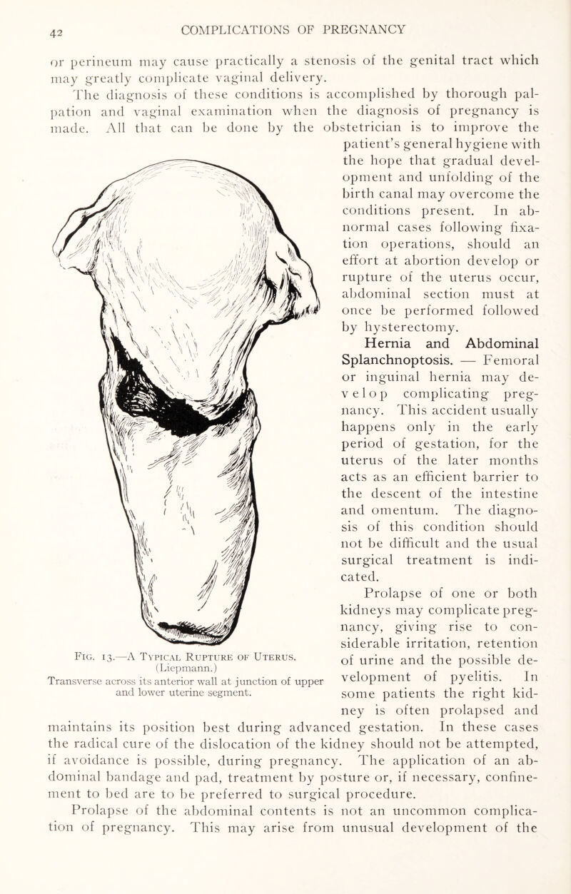 or perineum may cause practically a stenosis of the genital tract which may greatly complicate vaginal delivery. The diagnosis of these conditions is accomplished by thorough pal¬ pation and vaginal examination when the diagnosis of pregnancy is made. All that can be done by the obstetrician is to improve the patient’s general hygiene with the hope that gradual devel¬ opment and unfolding of the birth canal may overcome the conditions present. In ab¬ normal cases following fixa¬ tion operations, should an effort at abortion develop or rupture of the uterus occur, abdominal section must at once be performed followed by hysterectomy. Hernia and Abdominal Splanchnoptosis. — Femoral or inguinal hernia may de- velop complicating preg¬ nancy. This accident usually happens only in the early period of gestation, for the uterus of the later months acts as an efficient barrier to the descent of the intestine and omentum. The diagno¬ sis of this condition should not be difficult and the usual surgical treatment is indi¬ cated. Prolapse of one or both kidneys may complicate preg¬ nancy, giving rise to con¬ siderable irritation, retention of urine and the possible de¬ velopment of pyelitis. In some patients the right kid¬ ney is often prolapsed and maintains its position best during advanced gestation. In these cases the radical cure of the dislocation of the kidney should not be attempted, if avoidance is possible, during pregnancy. The application of an ab¬ dominal bandage and pad, treatment by posture or, if necessary, confine¬ ment to bed are to be preferred to surgical procedure. Prolapse of the abdominal contents is not an uncommon complica¬ tion of pregnancy. This may arise from unusual development of the Fig. 13.—A Typical Rupture of Uterus. (Liepmann.) Transverse across its anterior wall at junction of upper and lower uterine segment.
