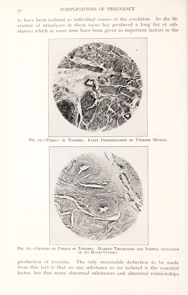 to have been isolated as individual causes of the condition. So the lit¬ erature of urinalyses in these cases has produced a long- list of sub¬ stances which at some time have been given as important factors in the Fig. 17.—Uterus in Toxemia; Fatty Degeneration of Uterine Muscle. Fig. 18.—Changes in Uterus in Toxemia; Marked Thickening and Partial Occlusion of its Blood-Vessels. production of toxemia. The only reasonable deduction from this fact is that no one substance so far isolated is factor, but that many abnormal substances and abnormal to be made the essential relationships