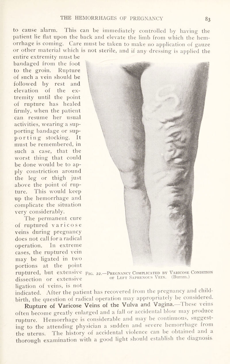 to cause alarm. 1 his can be immediately controlled by having the patient lie flat upon the back and elevate the limb from which the hem¬ orrhage is coming. Care must be taken to make no application of gauze or other material which is not sterile, and if any dressing is applied the entire extremity must be bandaged from the foot to the groin. Rupture of such a vein should be followed by rest and elevation of the ex¬ tremity until the point of rupture has healed firmly, when the patient can resume her usual activities, wearing a sup¬ porting bandage or sup- p or ting stocking. It must be remembered, in such a case, that the worst thing that could be done would be to ap¬ ply constriction around the leg or thigh just above the point of rup¬ ture. This would keep up the hemorrhage and complicate the situation very considerably. The permanent cure of ruptured varicose veins during pregnancy does not call for a radical operation. In extreme cases, the ruptured vein may be ligated in two portions at the point ruptured, but extensive fIG. 22— Pregnancy Complicated by Varicose; Condition dissection or extensive of Left Saphenous Vein. (Bumm.) ligation of veins, is not indicated. After the patient has recovered from the pregnancy and child¬ birth, the question of radical operation may appropriately be considered. Rupture of Varicose Veins of the Vulva and Vagina. Ihese veins often become greatly enlarged and a fall or accidental blow may produce rupture. Hemorrhage is considerable and may be continuous, suggest¬ ing to the attending physician a sudden and severe hemorrhage from the uterus. The history of accidental violence can be obtained and a thorough examination with a good light should establish the diagnosis.