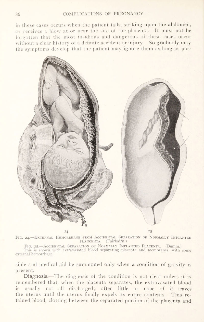 in these cases occurs when the patient falls, striking upon the abdomen, or receives a blow at or near the site of the placenta. It must not be forgotten that the most insidious and dangerous of these cases occur without a clear history of a definite accident or injury. So gradually may the symptoms develop that the patient may ignore them as long as pos- Fig. 24.—External Hemorrhage from Accidental Separation of Normally Implanted Plancenta. (Fairbairn.) Fig. 25.—Accidental Separation of Normally Implanted Placenta. (Bumm.) This is shown with extravasated blood separating placenta and membranes, with some external hemorrhage. sible and medical aid be summoned only when a condition of gravity is present. Diagnosis.—The diagnosis of the condition is not clear unless it is remembered that, when the placenta separates, the extravasated blood is usually not all discharged; often little or none of it leaves the uterus until the uterus finally expels its entire contents. This re¬ tained blood, clotting between the separated portion of the placenta and