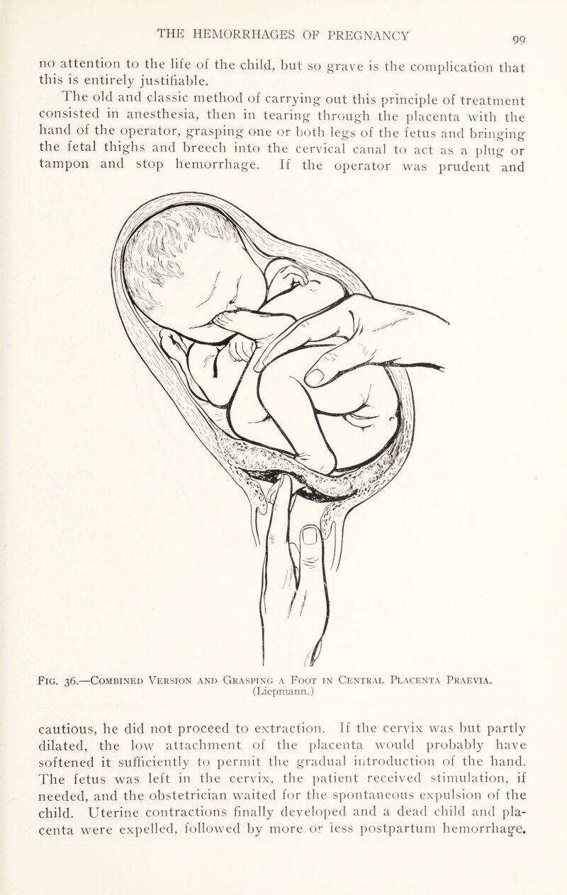 no attention to the life of the child, but so grave is the complication that this is entirely justifiable. The old and classic method of carrying- out this principle of treatment consisted in anesthesia, then in tearing through the placenta with the hand of the operator, grasping- one or both legs of the fetus and bringing the fetal thighs and breech into the cervical canal to act as a plug or tampon and stop hemorrhage. If the operator was prudent and Fig. 36.—Combined Version and Grasping a Foot in Central Placenta Praevia. (Liepmann.) cautious, he did not proceed to extraction. If the cervix was but partly dilated, the low attachment of the placenta would probably have softened it sufficiently to permit the gradual introduction of the hand. The fetus was left in the cervix, the patient received stimulation, if needed, and the obstetrician waited for the spontaneous expulsion of the child. Uterine contractions finally developed and a dead child and pla¬ centa were expelled, followed by more or less postpartum hemorrhage.