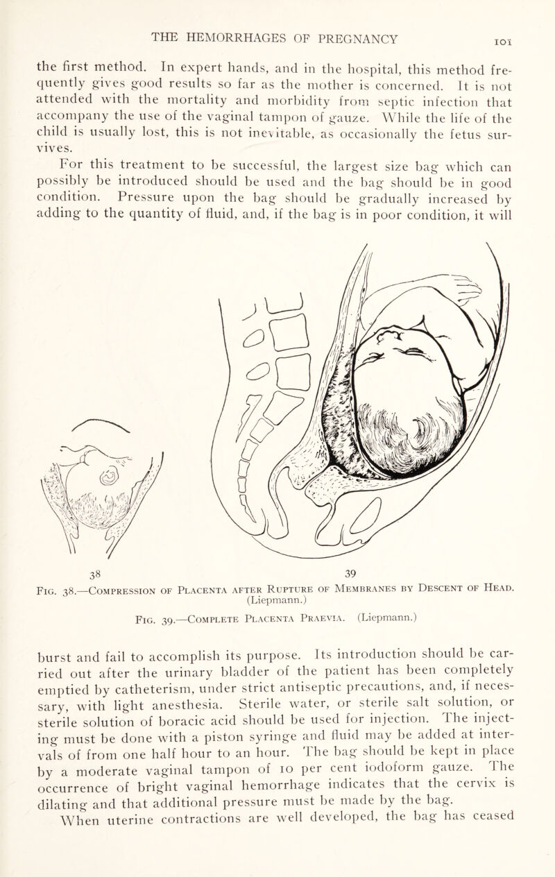IOI the first method. In expert hands, and in the hospital, this method fre¬ quently gives good results so far as the mother is concerned. It is not attended with the mortality and morbidity from septic infection that accompany the use of the vaginal tampon of gauze. While the life of the child is usually lost, this is not inevitable, as occasionally the fetus sur¬ vives. For this treatment to be successful, the largest size bag which can possibly be introduced should be used and the bag should be in good condition. Pressure upon the bag should be gradually increased by adding to the quantity of fluid, and, if the bag is in poor condition, it will 39 Fig. 38.—Compression of Placenta after Rupture of Membranes by Descent of Head. (Liepmann.) Fig. 39.—Complete Placenta Praevia. (Liepmann.) burst and fail to accomplish its purpose. Its introduction should be car¬ ried out after the urinary bladder of the patient has been completely emptied by catheterism, under strict antiseptic precautions, and, if neces¬ sary, with light anesthesia. Sterile water, or sterile salt solution, or sterile solution of boracic acid should be used for injection. The inject¬ ing must be done with a piston syringe and fluid may be added at intei vats of from one half hour to an hour. The bag should be kept in place by a moderate vaginal tampon of 10 per cent iodoform gauze. the occurrence of bright vaginal hemorrhage indicates that the cervix is dilating and that additional pressure must he made by the bag. When uterine contractions are well developed, the bag has ceased