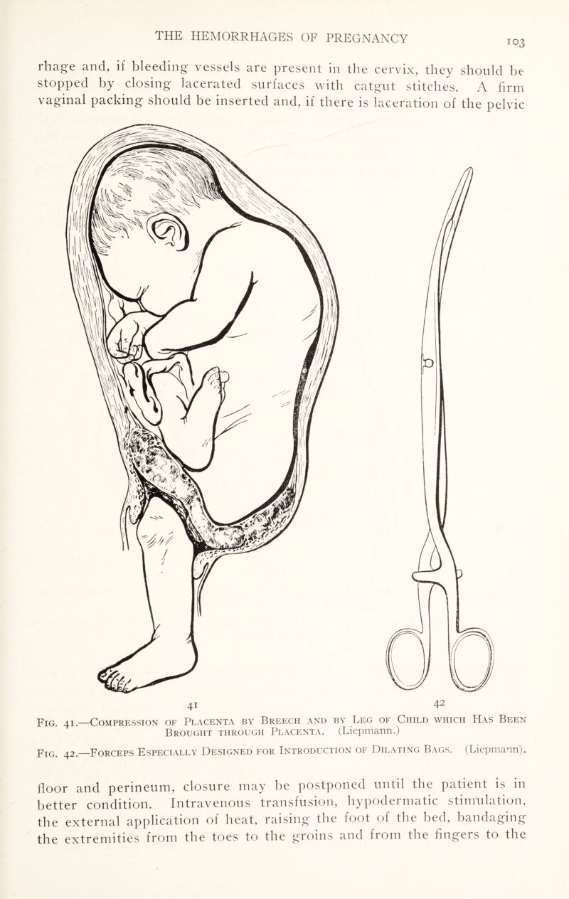 103 rhage and, if bleeding vessels are present in the cervix, they should be stopped by closing lacerated surfaces with catgut stitches. A firm vaginal packing should be inserted and, if there is laceration of the pelvic Fig. 41.—Compression of Placenta by Breech and by Leg of Child which Has Been Brought through Placenta. (Liepmann.) Fig. 42.—Forceps Especially Designed for Introduction of Dilating Bags. (Liepniann). floor and perineum, closure may be postponed until the patient is in better condition. Intravenous transfusion, hypodermatic stimulation, the external application of heat, raising- the loot of the bed, bandaging the extremities from the toes to the groins and from the fingers to the
