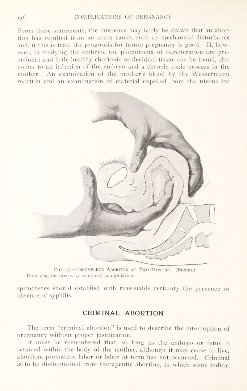 From these statements, the inference may fairly be drawn that an abor¬ tion has resulted from an acute cause, such as mechanical disturbance and, if this is true, the prognosis for future pregnancy is good. If, how¬ ever, in studying the embryo, the phenomena of degeneration are pre¬ eminent and little healthy chorionic or decidual tissue can be found, this points to an infection of the embryo and a chronic toxic process in the mother. An examination of the mother’s blood by the Wassermann reaction and an examination of material expelled from the uterus for Fig. 47.—Incomplete Abortion at Two Months. (Bumm.) Emptying the uterus by combined manipulation. spirochetes should establish with reasonable certainty the presence or absence of syphilis. CRIMINAL ABORTION The term “criminal abortion” is used to describe the interruption of pregnancy without proper justification. It must be remembered that, so long as the embryo or fetus is retained within the body of the mother, although it may cease to live, abortion, premature labor or labor at term has not occurred. Criminal is to be distinguished from therapeutic abortion, in which some indica-