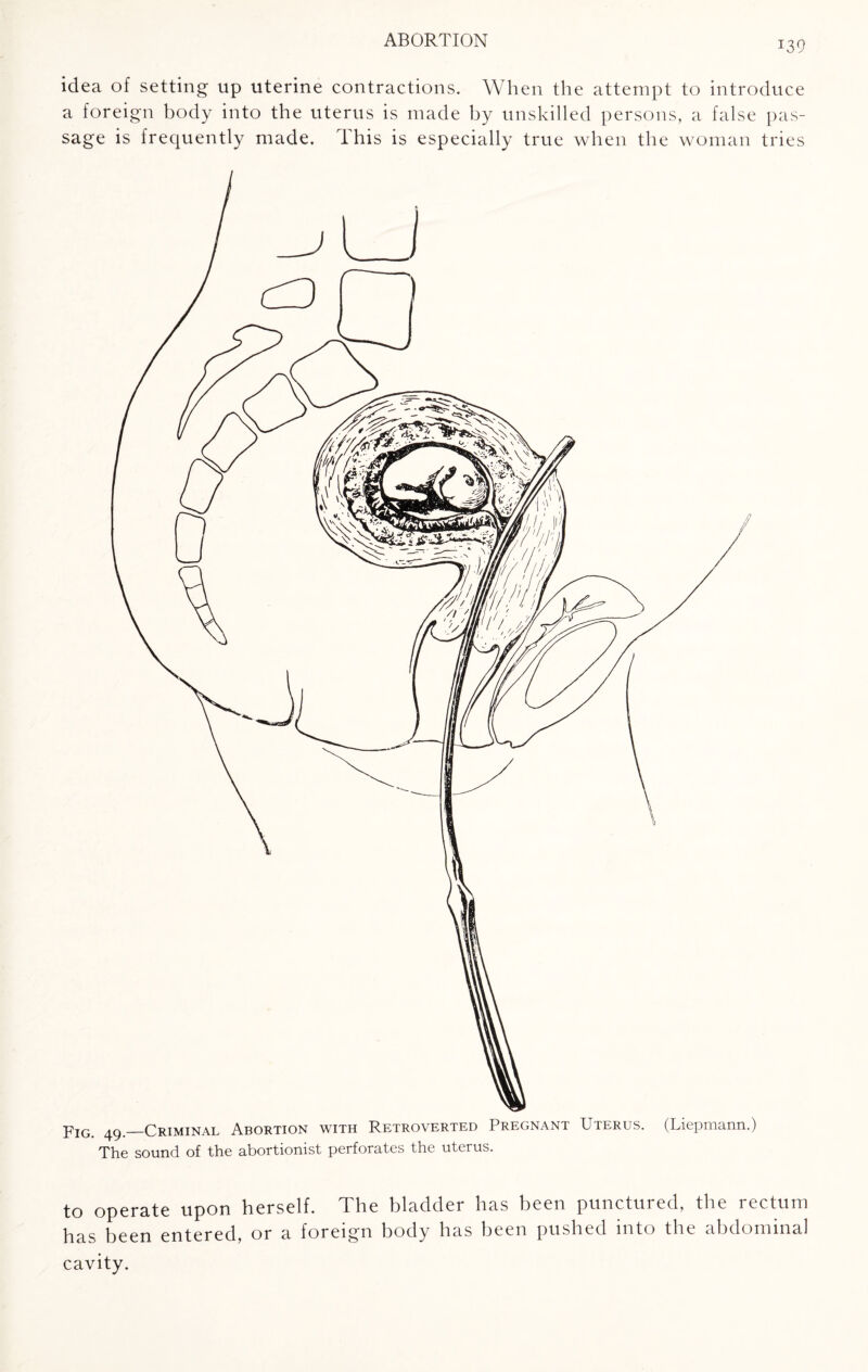 130 idea of setting up uterine contractions. When the attempt to introduce a foreign body into the uterus is made by unskilled persons, a false pas¬ sage is frequently made. This is especially true when the woman tries to operate upon herself. The bladder has been punctured, the rectum has been entered, or a foreign body has been pushed into the abdominal cavity.