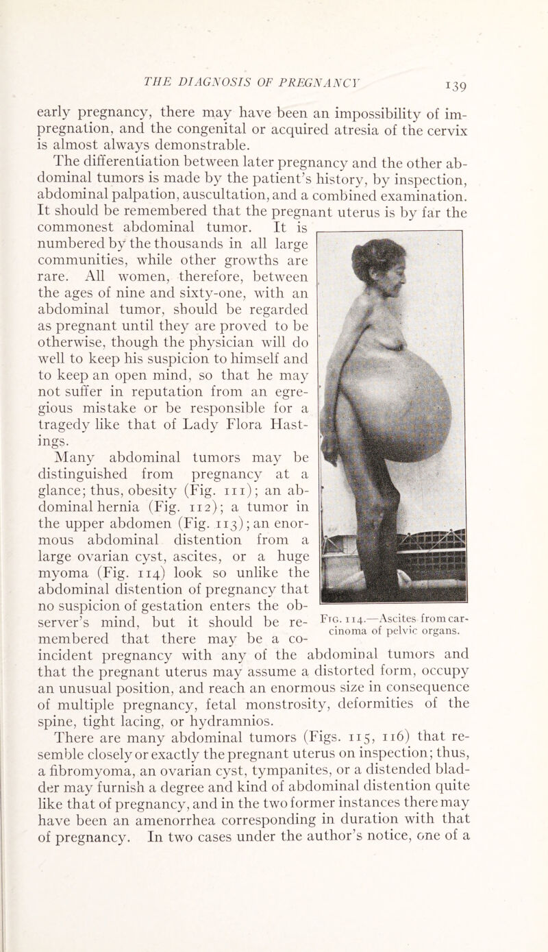 early pregnancy, there may have been an impossibility of im¬ pregnation, and the congenital or acquired atresia of the cervix is almost always demonstrable. The differentiation between later pregnancy and the other ab¬ dominal tumors is made by the patient’s history, by inspection, abdominal palpation, auscultation, and a combined examination. It should be remembered that the pregnant uterus is by far the commonest abdominal tumor. It is numbered by the thousands in all large communities, while other growths are rare. All women, therefore, between the ages of nine and sixty-one, with an abdominal tumor, should be regarded as pregnant until they are proved to be otherwise, though the physician will do well to keep his suspicion to himself and to keep an open mind, so that he may not suffer in reputation from an egre¬ gious mistake or be responsible for a tragedy like that of Lady Flora Hast¬ ings. Many abdominal tumors may be distinguished from pregnancy at a glance; thus, obesity (Fig. m); an ab¬ dominal hernia (Fig. 112); a tumor in the upper abdomen (Fig. ii3);an enor¬ mous abdominal distention from a large ovarian cyst, ascites, or a huge myoma (Fig. 114) look so unlike the abdominal distention of pregnancy that no suspicion of gestation enters the ob¬ server’s mind, but it should be re¬ membered that there may be a co- Ftg. 114.—Ascites from car¬ cinoma of pelvic organs. incident pregnancy with any of the abdominal tumors and that the pregnant uterus may assume a distorted form, occupy an unusual position, and reach an enormous size in consequence of multiple pregnancy, fetal monstrosity, deformities of the spine, tight lacing, or hydramnios. There are many abdominal tumors (Figs. 115, 116) that re¬ semble closely or exactly the pregnant uterus on inspection ; thus, a fibromyoma, an ovarian cyst, tympanites, or a distended blad¬ der may furnish a degree and kind of abdominal distention quite like that of pregnancy, and in the two former instances there may have been an amenorrhea corresponding in duration with that of pregnancy. In two cases under the author’s notice, one of a