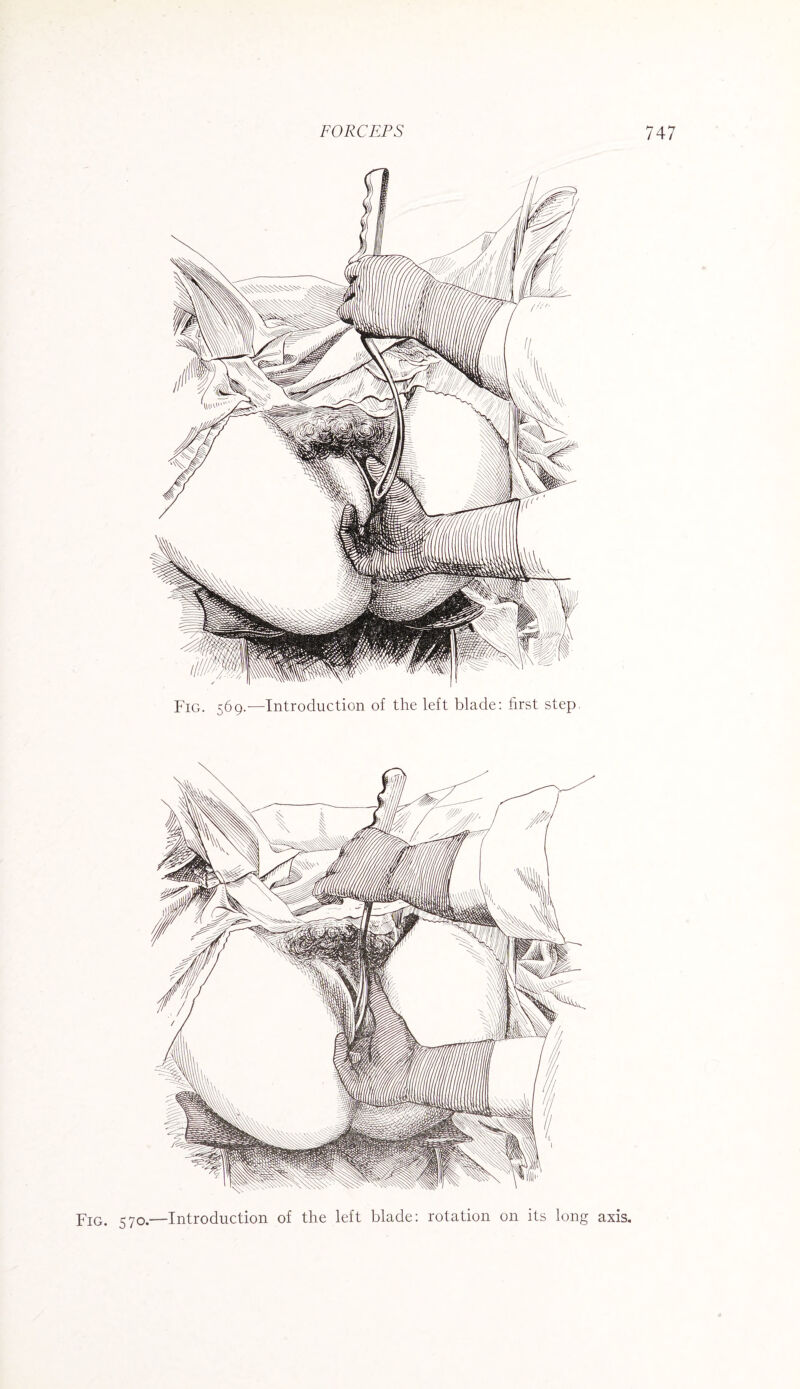 Fig. 569.—Introduction of the left blade: first step. Fig. 570.—Introduction of the left blade: rotation on its long axis.