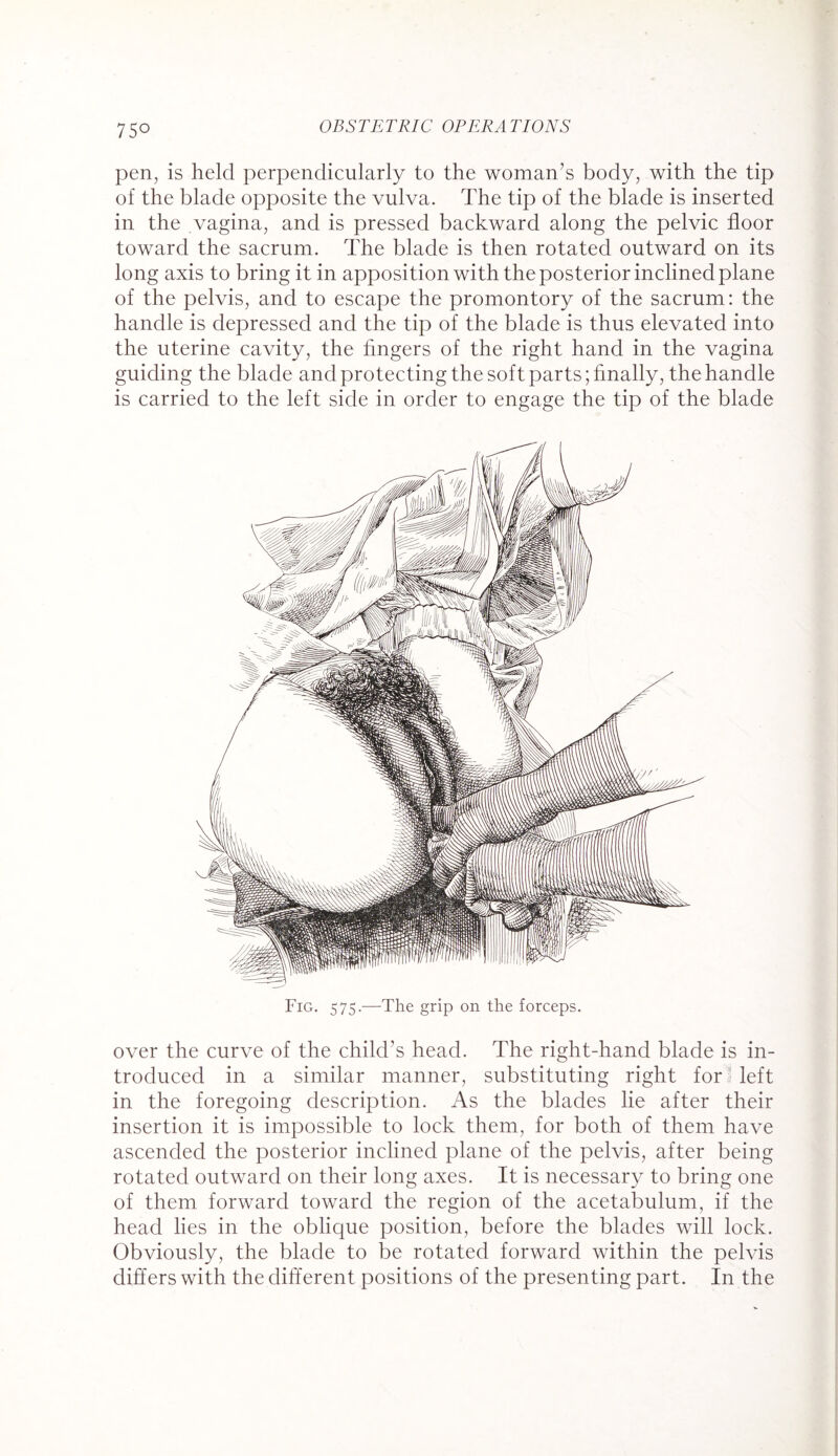 75° pen, is held perpendicularly to the woman’s body, with the tip of the blade opposite the vulva. The tip of the blade is inserted in the vagina, and is pressed backward along the pelvic floor toward the sacrum. The blade is then rotated outward on its long axis to bring it in apposition with the posterior inclined plane of the pelvis, and to escape the promontory of the sacrum: the handle is depressed and the tip of the blade is thus elevated into the uterine cavity, the fingers of the right hand in the vagina guiding the blade and protecting the soft parts; finally, the handle is carried to the left side in order to engage the tip of the blade Fig. 575.—The grip on the forceps. over the curve of the child’s head. The right-hand blade is in¬ troduced in a similar manner, substituting right for i left in the foregoing description. As the blades lie after their insertion it is impossible to lock them, for both of them have ascended the posterior inclined plane of the pelvis, after being rotated outward on their long axes. It is necessary to bring one of them forward toward the region of the acetabulum, if the head lies in the oblique position, before the blades will lock. Obviously, the blade to be rotated forward within the pelvis differs with the different positions of the presenting part. In the