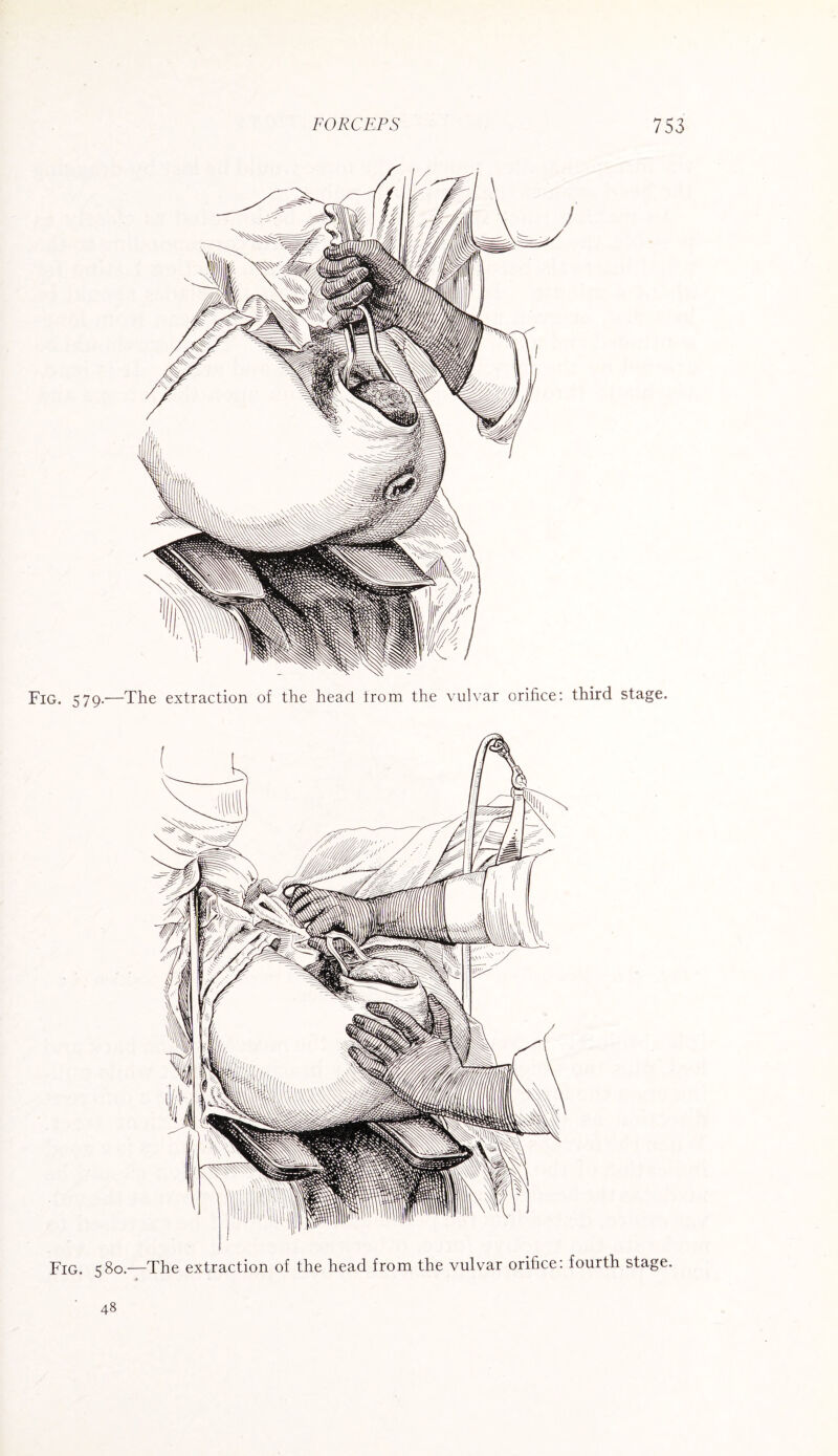 Fig. 579.—The extraction of the heart irom the vulvar orifice: third stage. Fig. 580.—The extraction of the head from the vulvar orifice: fourth stage. 48