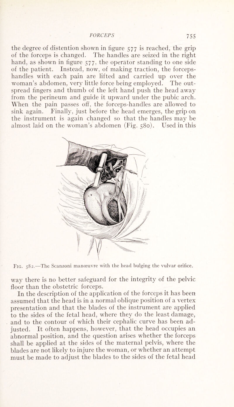 the degree of distention shown in figure 577 is reached, the grip of the forceps is changed. The handles are seized in the right hand, as shown in figure 577, the operator standing to one side of the patient. Instead, now, of making traction, the forceps- handles with each pain are lifted and carried up over the woman’s abdomen, very little force being employed. The out¬ spread fingers and thumb of the left hand push the head away from the perineum and guide it upward under the pubic arch. When the pain passes off, the forceps-handles are allowed to sink again. Finally, just before the head emerges, the grip on the instrument is again changed so that the handles may be almost laid on the woman’s abdomen (Fig. 580). Used in this Fig. 582.—The Scanzoni manoeuvre with the head bulging the vulvar orifice. way there is no better safeguard for the integrity of the pelvic floor than the obstetric forceps. In the description of the application of the forceps it has been assumed that the head is in a normal oblique position of a vertex presentation and that the blades of the instrument are applied to the sides of the fetal head, where they do the least damage, and to the contour of which their cephalic curve has been ad¬ justed. It often happens, however, that the head occupies an abnormal position, and the question arises whether the forceps shall be applied at the sides of the maternal pelvis, where the blades are not likely to injure the woman, or whether an attempt must be made to adjust the blades to the sides of the fetal head