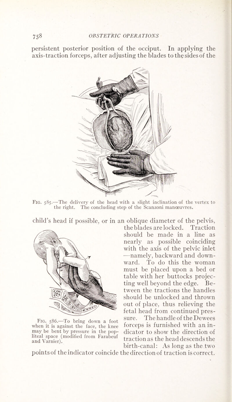 persistent posterior position of the occiput. In applying the axis-traction forceps, after adjusting the blades to the sides of the Fig. 585.-—The delivery of the head with a slight inclination of the vertex to the right. The concluding step of the Scanzoni manoeuvres. child’s head if possible, or in an oblique diameter of the pelvis, the blades are locked. Traction should be made in a line as nearly as possible coinciding with the axis of the pelvic inlet -—namely, backward and down¬ ward. To do this the woman must be placed upon a bed or table with her buttocks projec¬ ting well beyond the edge. Be¬ tween the tractions the handles should be unlocked and thrown out of place, thus relieving the fetal head from continued pres- .n/r rp -i • j , ^ sure. The handle of the Dewees tig. 586.— lo bring down a foot c r . . . . . when it is against the face, the knee lorceps IS furnished With an in¬ may be bent by pressure in the pop- dicator to show the direction of and Va?nfer)!m0difaed *r°m traction as the head descends the birth-canal: As long as the two points of the indicator coincide the direction of traction is correct.