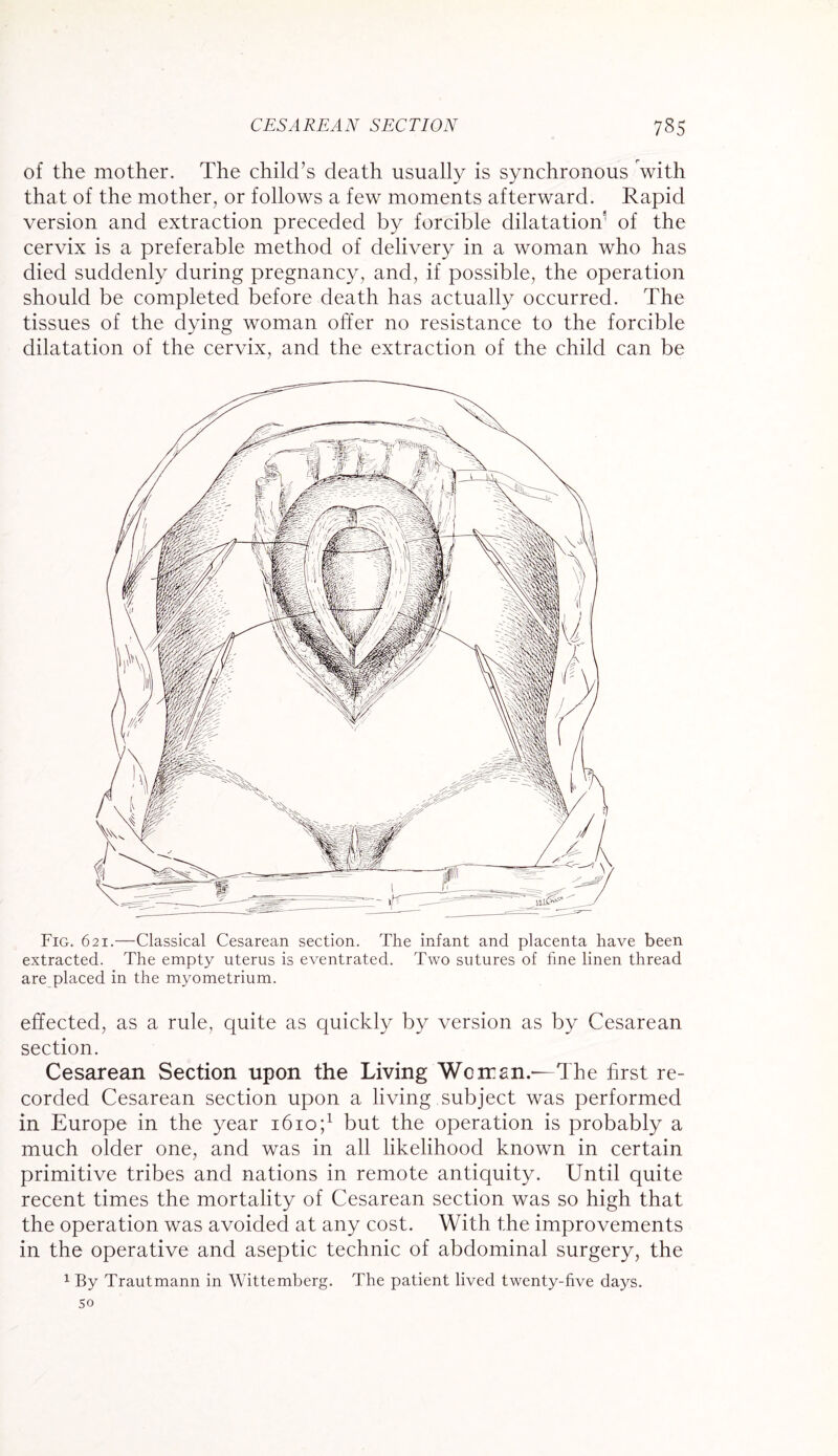 of the mother. The child’s death usually is synchronous with that of the mother, or follows a few moments afterward. Rapid version and extraction preceded by forcible dilatation’ of the cervix is a preferable method of delivery in a woman who has died suddenly during pregnancy, and, if possible, the operation should be completed before death has actually occurred. The tissues of the dying woman offer no resistance to the forcible dilatation of the cervix, and the extraction of the child can be Fig. 621.—Classical Cesarean section. The infant and placenta have been extracted. The empty uterus is eventrated. Two sutures of fine linen thread are placed in the myometrium. effected, as a rule, quite as quickly by version as by Cesarean section. Cesarean Section upon the Living Wcirsn.—The first re¬ corded Cesarean section upon a living subject was performed in Europe in the year 1610 ;L but the operation is probably a much older one, and was in all likelihood known in certain primitive tribes and nations in remote antiquity. Until quite recent times the mortality of Cesarean section was so high that the operation was avoided at any cost. With the improvements in the operative and aseptic technic of abdominal surgery, the 1 By Trautmann in Wittemberg. The patient lived twenty-five days, so