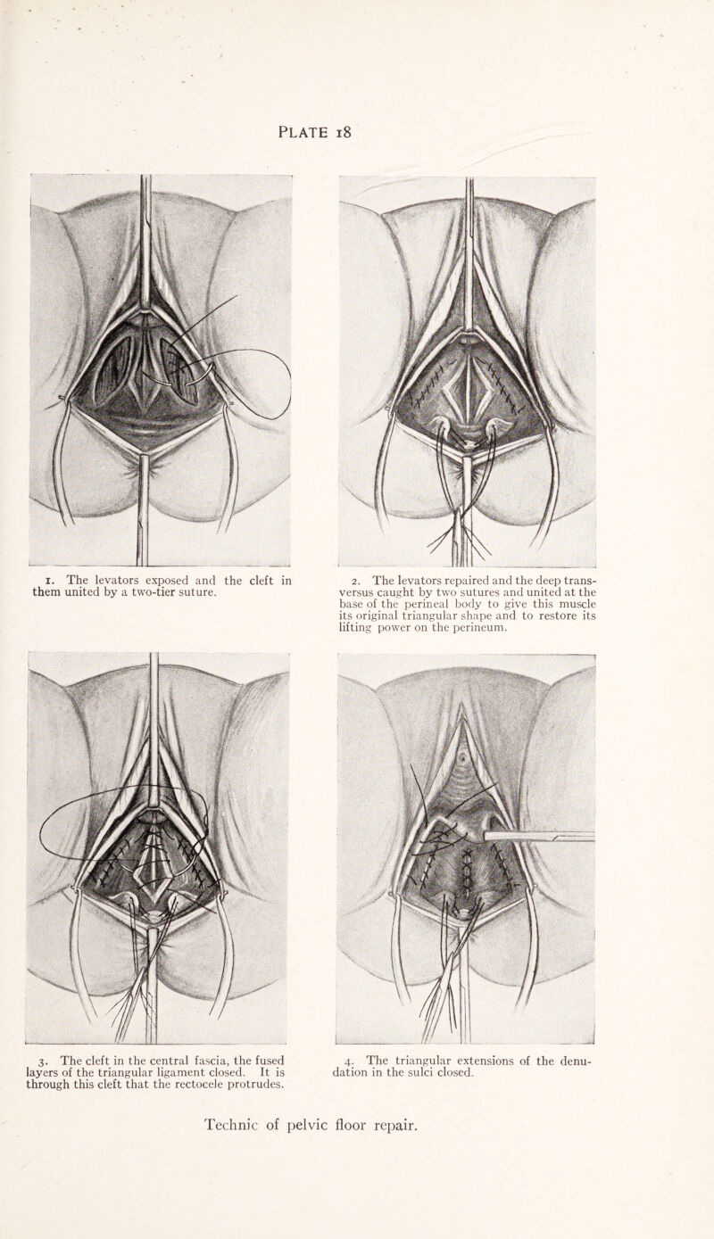 PLATE 18 2. The levators repaired and the deep trans- versus caught by two sutures and united at the base of the perineal body to give this muscle its original triangular shape and to restore its lifting power on the perineum. x. The levators exposed and the cleft in them united by a two-tier suture. 3. The cleft in the central fascia, the fused 4. The triangular extensions of the denu- layers of the triangular ligament closed. It is dation in the sulci closed, through this cleft that the rectocele protrudes.