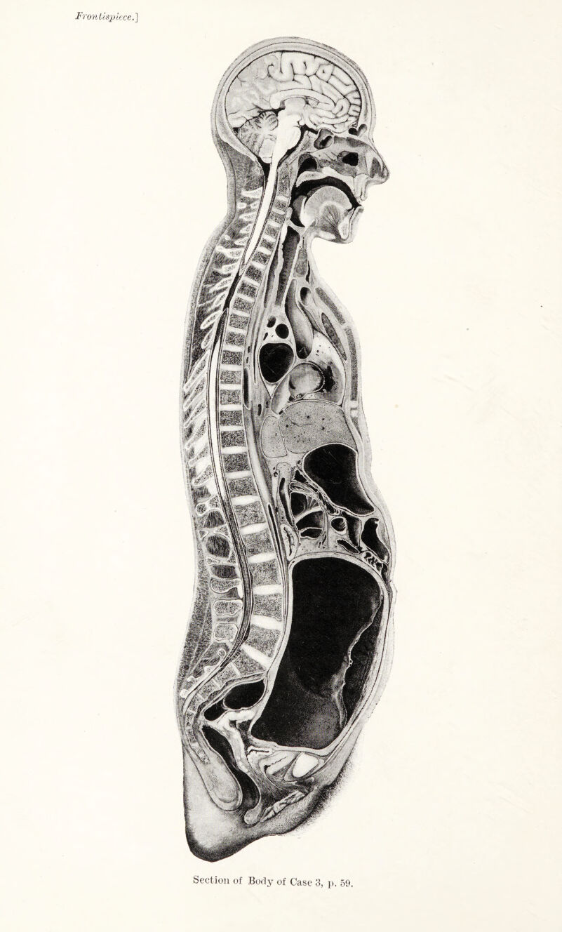 Frontispiece.] Section of Body of Case 3, p. 59.