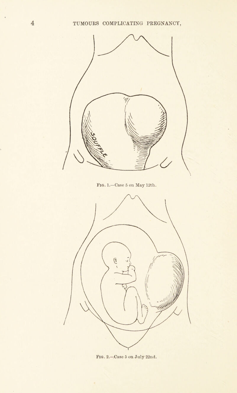 Fig. 1.—Case 5 on May 12th. Fig. 2.—Case 5 on July 22nd.