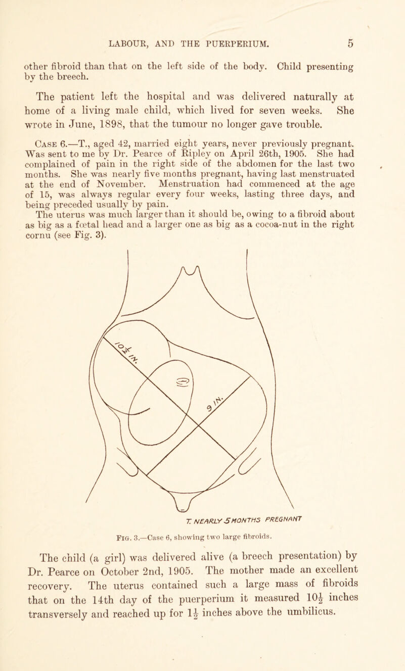 other fibroid than that on the left side of the body. Child presenting by the breech. The patient left the hospital and was delivered naturally at home of a living male child, which lived for seven weeks. She wrote in June, 1898, that the tumour no longer gave trouble. Case 6.—T., aged 42, married eight years, never previously pregnant. Was sent to me by Dr. Pearce of Ripley on April 26th, 1905. She had complained of pain in the right side of the abdomen for the last two months. She was nearly five months pregnant, having last menstruated at the end of November. Menstruation had commenced at the age of 15, was always regular every four weeks, lasting three days, and being preceded usually by pain. The uterus was much larger than it should be, owing to a fibroid about as big as a foetal head and a larger one as big as a cocoa-nut in the right cornu (see Fig. 3). Fig. 3—Case 6, showing two large fibroids. The child (a girl) was delivered alive (a breech presentation) by Dr. Pearce on October 2nd, 1905. The mother made an excellent recovery. The uterus contained such a large mass of fibroids that on the 14th day of the puerperium it measured 10\ inches transversely and reached up for 1^ inches above the umbilicus.