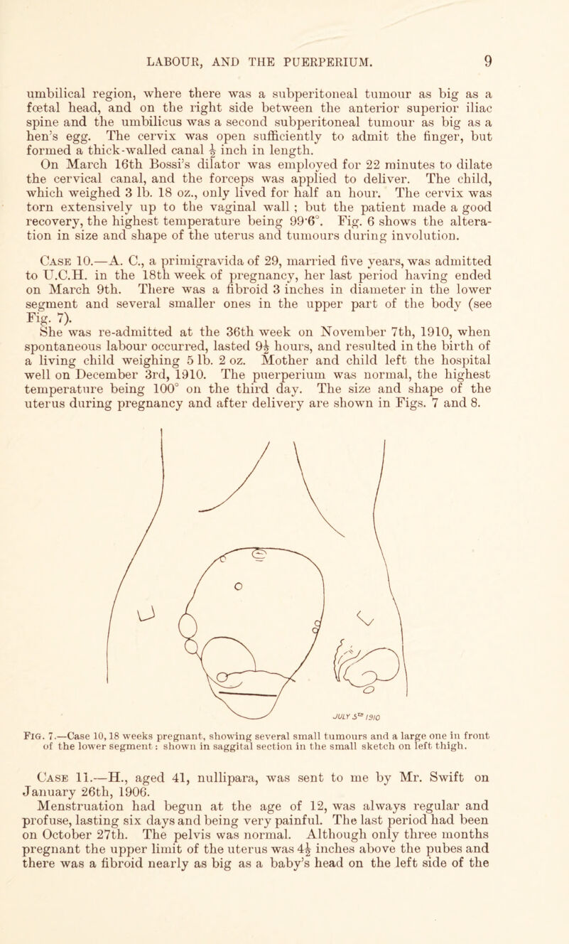 umbilical region, where there was a subperitoneal tumour as big as a foetal head, and on the right side between the anterior superior iliac spine and the umbilicus was a second subperitoneal tumour as big as a hen’s egg. The cervix was open sufficiently to admit the finger, but formed a thick-walled canal \ inch in length. On March 16th Bossi’s dilator was employed for 22 minutes to dilate the cervical canal, and the forceps was applied to deliver. The child, which weighed 3 lb. 18 oz., only lived for half an hour. The cervix was torn extensively up to the vaginal wall ; but the patient made a good recovery, the highest temperature being 99’6°. Fig. 6 shows the altera¬ tion in size and shape of the uterus and tumours during involution. Case 10.—A. C., a primigravida of 29, married five years, was admitted to U.C.H. in the 18th week of pregnancy, her last period having ended on March 9th. There was a fibroid 3 inches in diameter in the lower segment and several smaller ones in the upper part of the body (see Fig. 7). She was re-admitted at the 36th week on November 7th, 1910, when spontaneous labour occurred, lasted 9^ hours, and resulted in the birth of a living child weighing 5 lb. 2 oz. Mother and child left the hospital well on December 3rd, 1910. The puerperium was normal, the highest temperature being 100° on the third day. The size and shape of the uterus during pregnancy and after delivery are shown in Figs. 7 and 8. Fig. 7.—Case 10,18 weeks pregnant, showing several small tumours and a large one in front of the lower segment -. shown in saggital section in the small sketch on left thigh. Case 11.—H., aged 41, nullipara, was sent to me by Mr. Swift on January 26th, 1906. Menstruation had begun at the age of 12, was always regular and profuse, lasting six days and being very painful. The last period had been on October 27th. The pelvis was normal. Although only three months pregnant the upper limit of the uterus was 4^ inches above the pubes and there was a fibroid nearly as big as a baby’s head on the left side of the