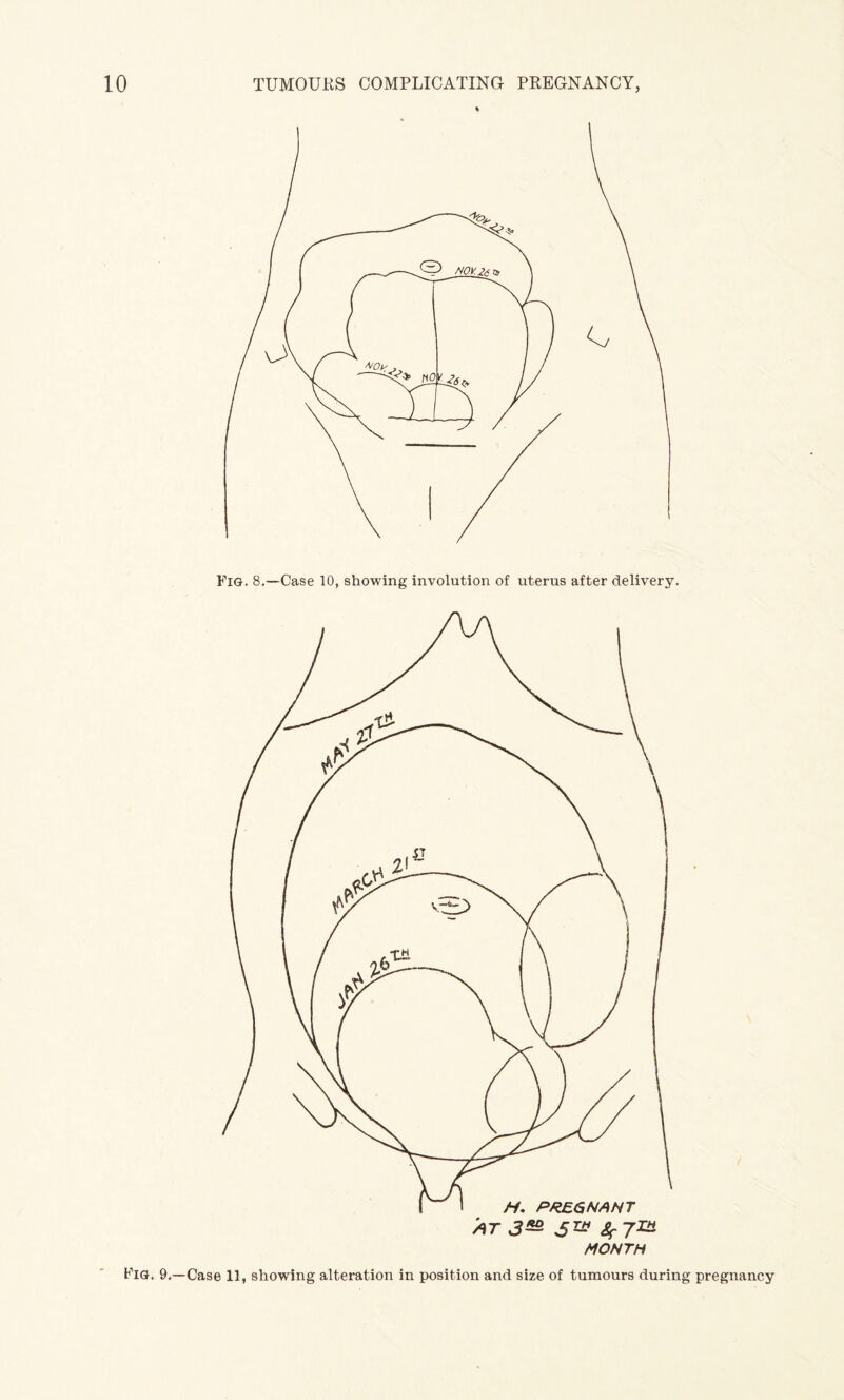 Fig. 8.—Case 10, showing involution of uterus after delivery. Fig. 9.—Case 11, showing alteration in position and size of tumours during pregnancy