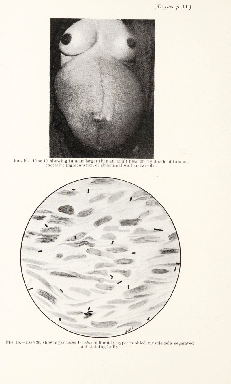 (To face p. 11.) Fig. 15.—Case 30, showing bacillus Welchh, in fibroid ; hypertrophied muscle cells separated and staining badly.