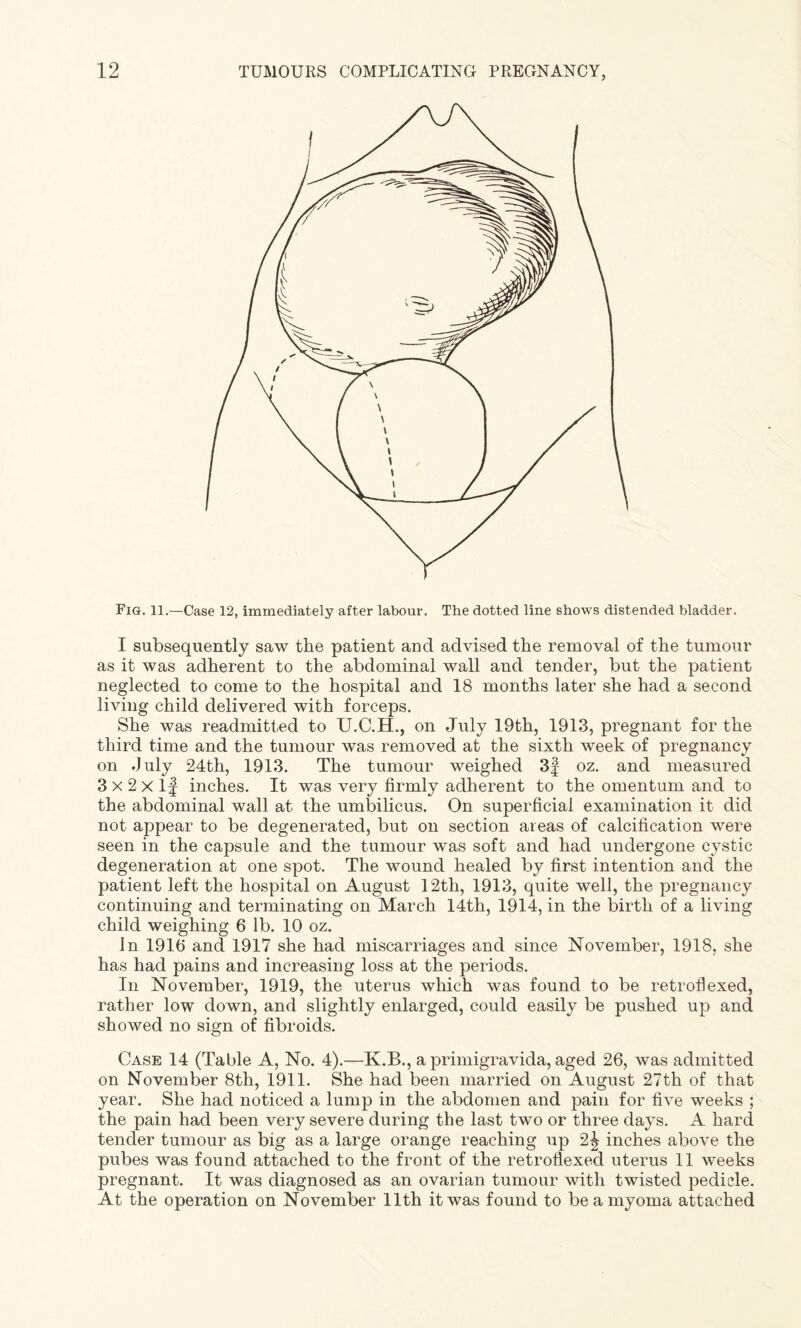 Fig. 11.—Case 12, immediately after labour. The dotted line shows distended bladder. I subsequently saw the patient and advised the removal of the tumour as it was adherent to the abdominal wall and tender, but the patient neglected to come to the hospital and 18 months later she had a second living child delivered with forceps. She was readmitted to U.C.H., on July 19th, 1913, pregnant for the third time and the tumour was removed at the sixth week of pregnancy on July 24th, 1913. The tumour weighed 3f oz. and measured 3 x 2 X If inches. It was very firmly adherent to the omentum and to the abdominal wall at the umbilicus. On superficial examination it did not appear to be degenerated, but on section areas of calcification were seen in the capsule and the tumour was soft and had undergone cystic degeneration at one spot. The wound healed by first intention and the patient left the hospital on August 12th, 1913, quite well, the pregnancy continuing and terminating on March 14th, 1914, in the birth of a living child weighing 6 lb. 10 oz. In 1916 and 1917 she had miscarriages and since November, 1918, she has had pains and increasing loss at the periods. In November, 1919, the uterus which was found to be retroflexed, rather low down, and slightly enlarged, could easily be pushed up and showed no sign of fibroids. Case 14 (Table A, No. 4).—K.B., a primigravida, aged 26, was admitted on November 8th, 1911. She had been married on August 27th of that year. She had noticed a lump in the abdomen and pain for five weeks ; the pain had been very severe during the last two or three days. A hard tender tumour as big as a large orange reaching up 2^ inches above the pubes was found attached to the front of the retroflexed uterus 11 weeks pregnant. It was diagnosed as an ovarian tumour with twisted pedicle. At the operation on November 11th it was found to be a myoma attached