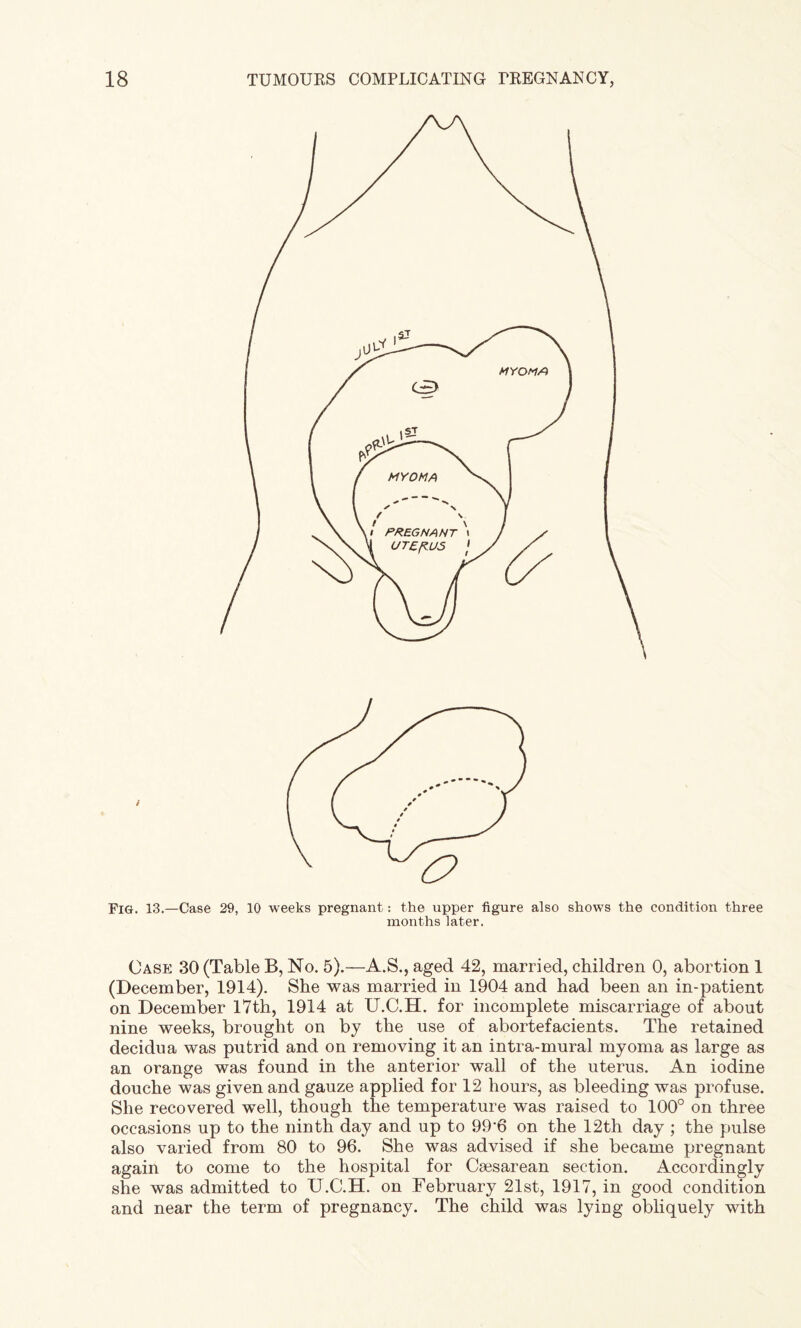 Fig. 13.—Case 29, 10 weeks pregnant: the upper figure also shows the condition three months later. Case 30 (Table B, No. 5).—A.S., aged 42, married, children 0, abortion 1 (December, 1914). She was married in 1904 and had been an in-patient on December 17th, 1914 at U.C.H. for incomplete miscarriage of about nine weeks, brought on by the use of abortefacients. The retained decidua was putrid and on removing it an intra-mural myoma as large as an orange was found in the anterior wall of the uterus. An iodine douche was given and gauze applied for 12 hours, as bleeding was profuse. She recovered well, though the temperature was raised to 100° on three occasions up to the ninth day and up to 99‘6 on the 12th day ; the pulse also varied from 80 to 96. She was advised if she became pregnant again to come to the hospital for Caesarean section. Accordingly she was admitted to TT.C.H. on February 21st, 1917, in good condition and near the term of pregnancy. The child was lying obliquely with