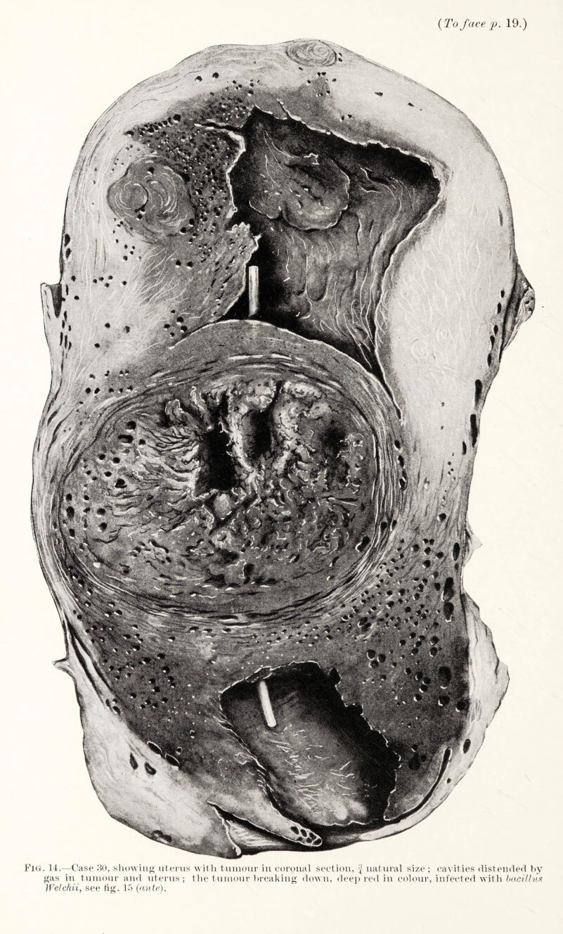 {To face p. 19.) ; >\ . 14.—Case 30, showing uterus with tumour in coronal section, f natural size ; cavities distended by gas in tumour and uterus; the tumour breaking down, deep red in colour, infected with bacillus Welchii, see tig. 15 (ante).