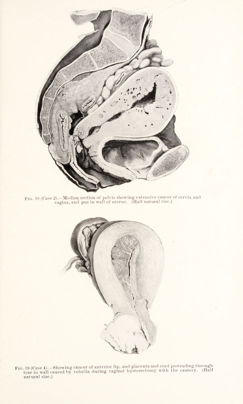 vagina, and pus in wall of uterus. (Half natural size.) Fig 19 (Case 4).—Showing cancer of anterior lip, and placenta and cord protruding through tear in wall caused by volsella during vaginal hysterectomy with the cautery. (Half natural size.)