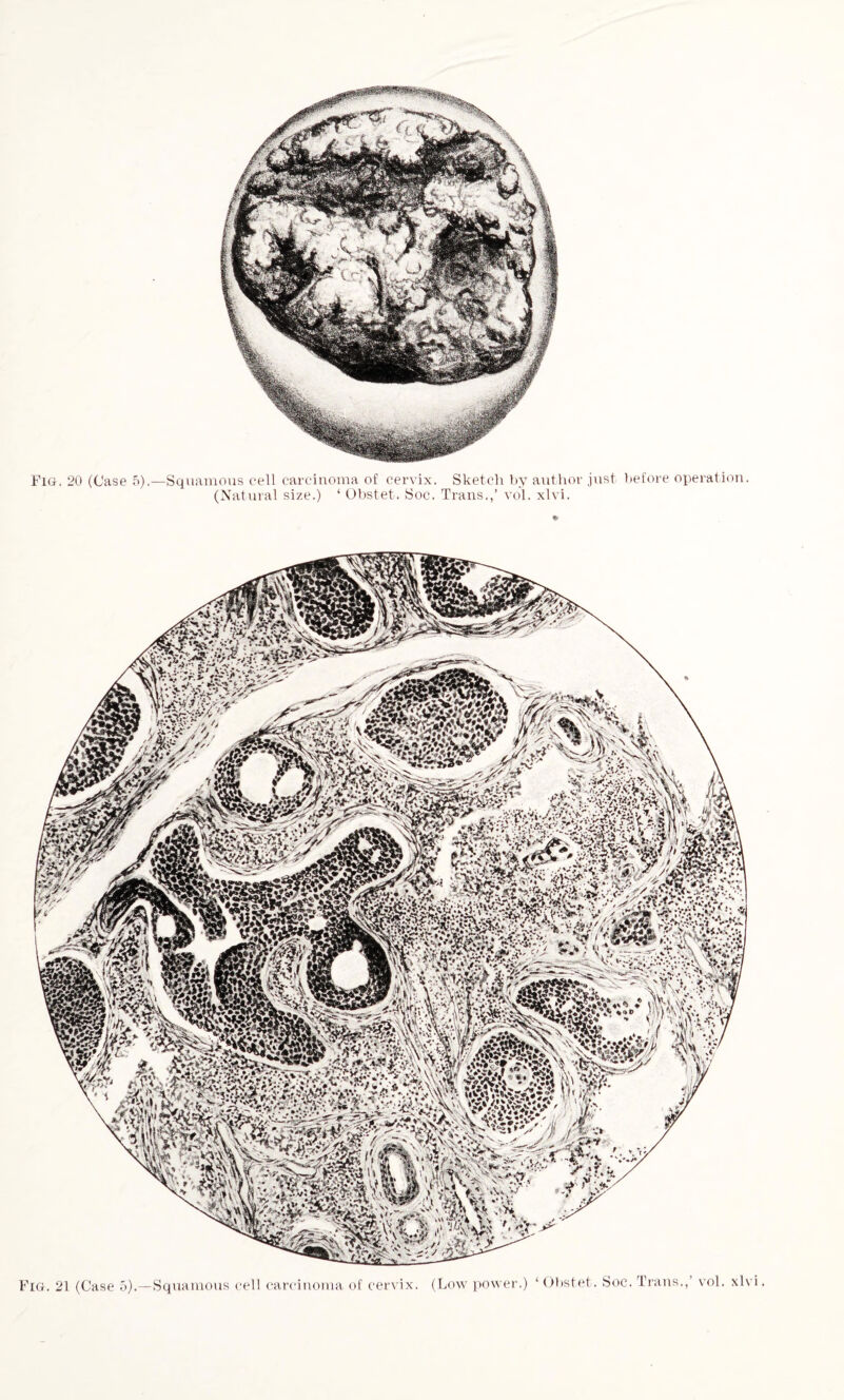 (Natural size.) ‘ Obstet. Soc. Trans.,’ vol. xlvi. Fig. 21 (Case 5).—Squamous cell carcinoma of cervix. (Low power.) ‘Obstet. Soc. Trans., vol. xlvi.