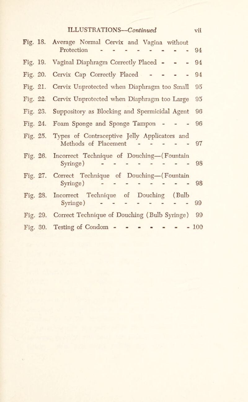 Fig. 18. Average Normal Cervix and Vagina without Protection - -- -- -- >94 Fig. 19. Vaginal Diaphragm Correctly Placed - - - 94 Fig. 20. Cervix Cap Correctly Placed - 94 Fig. 21. Cervix Unprotected when Diaphragm too Small 95 Fig. 22. Cervix Unprotected when Diaphragm too Large 95 Fig. 23. Suppository as Blocking and Spermicidal Agent 96 Fig. 24. Foam Sponge and Sponge Tampon - 96 Fig. 25. Types of Contraceptive Jelly Applicators and Methods of Placement ----- 97 Fig. 26. Incorrect Technique of Douching—(Fountain Syringe) - -- -- -- -98 Fig. 27. Correct Technique of Douching—(Fountain Syringe) ------ 98 Fig. 28. Incorrect Technique of Douching (Bulb Syringe) - -- -- -- -99 Fig. 29. Correct Technique of Douching (Bulb Syringe) 99 Fig. 30. Testing of Condom ------- 100