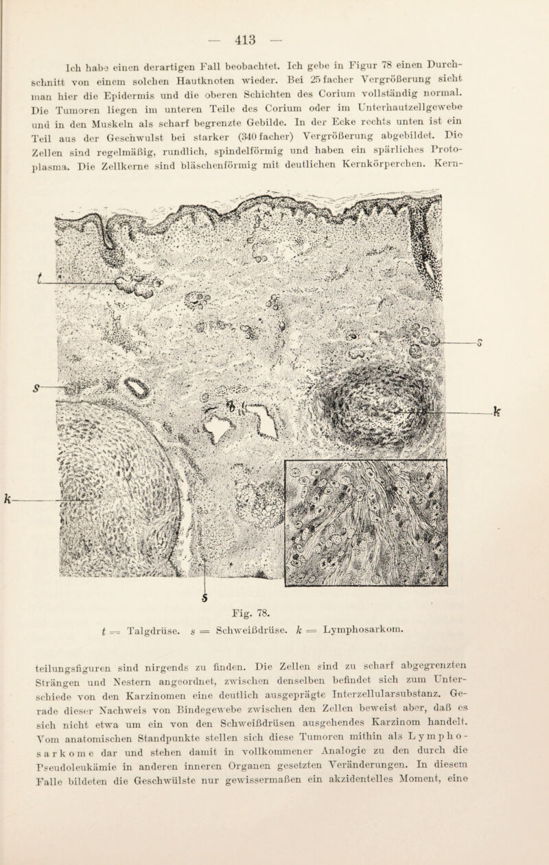 Ich habe eitlen derartigen Fall beobachtet. Ich gebe in Figur 78 einen Durcn schnitt von einem solchen Hautknoten wieder. Bei 25facher Vergrößerung sieht man hier die Epidermis und die oberen Schichten des Corium vollständig normal. Die Tumoren liegen im unteren Teile des Corium oder im Unterhautzellgcwebe und in den Muskeln als scharf begrenzte Gebilde. In der Ecke rechts unten ist ein Teil aus der Geschwulst bei starker (340 facher) Vergrößerung abgebildet. Die Zellen sind regelmäßig, rundlich, spindelförmig und haben ein spärliches Proto¬ plasma. Die Zellkerne sind bläschenförmig mit deutlichen Kernkörperchen. Kern- Fig. 78. t — Talgdrüse, s — Schweißdrüse, k = Lymphosarkom. teilungsfiguren sind nirgends zu fmden. Die Zellen sind zu scharf abgegrenzten Strängen und Nestern angeordnet, zwischen denselben befindet sich zum Lnter- schiede von den Karzinomen eine deutlich ausgeprägte Interzellularsubstanz. Ge¬ rade dieser Nachweis von Bindegewebe zwischen den Zellen beweist aber, daß es sich nicht etwa um ein von den Schweißdrüsen ausgehendes Karzinom handelt. Vom anatomischen Standpunkte stellen sich diese Tumoren mithin als Lympho¬ sarkome dar und stehen damit in vollkommener Analogie zu den durch die Pseudoleukämie in anderen inneren Organen gesetzten Veränderungen. In diesem Falle bildeten die Geschwülste nur gewissermaßen ein akzidentelles Moment, eine