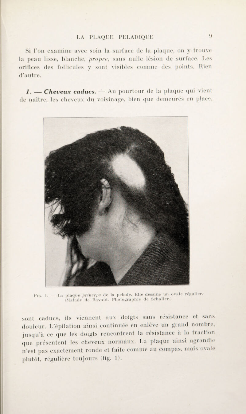 '.i Si l’on examine avec soin la surface de la plaque, on y trouve la peau lisse, blanche, propre, sans nulle lésion de surface. Les orifices des follicules y sont visibles comme des points. Rien d’autre. 1. — Cheveux caducs. — Au pourtour de de naître, les cheveux du voisinage, bien que la plaque qui vient demeurés en place, Fig. 1. I.a plaque princeps de la pelade. Elle dessine un ovale (Malade de Rav.nit. Photographie de Schaller.) régulier. sont caducs, ils viennent aux doigts sans résistance et sans douleur. L’épilation ainsi continuée en enlève un grand nombre, jusqu’à ce que les doigts rencontrent la résistance à la traction que présentent les cheveux normaux. La plaque ainsi agiandit n’est pas exactement ronde et faite comme au compas, mais ovale plutôt, régulière toujours (tig. 1).