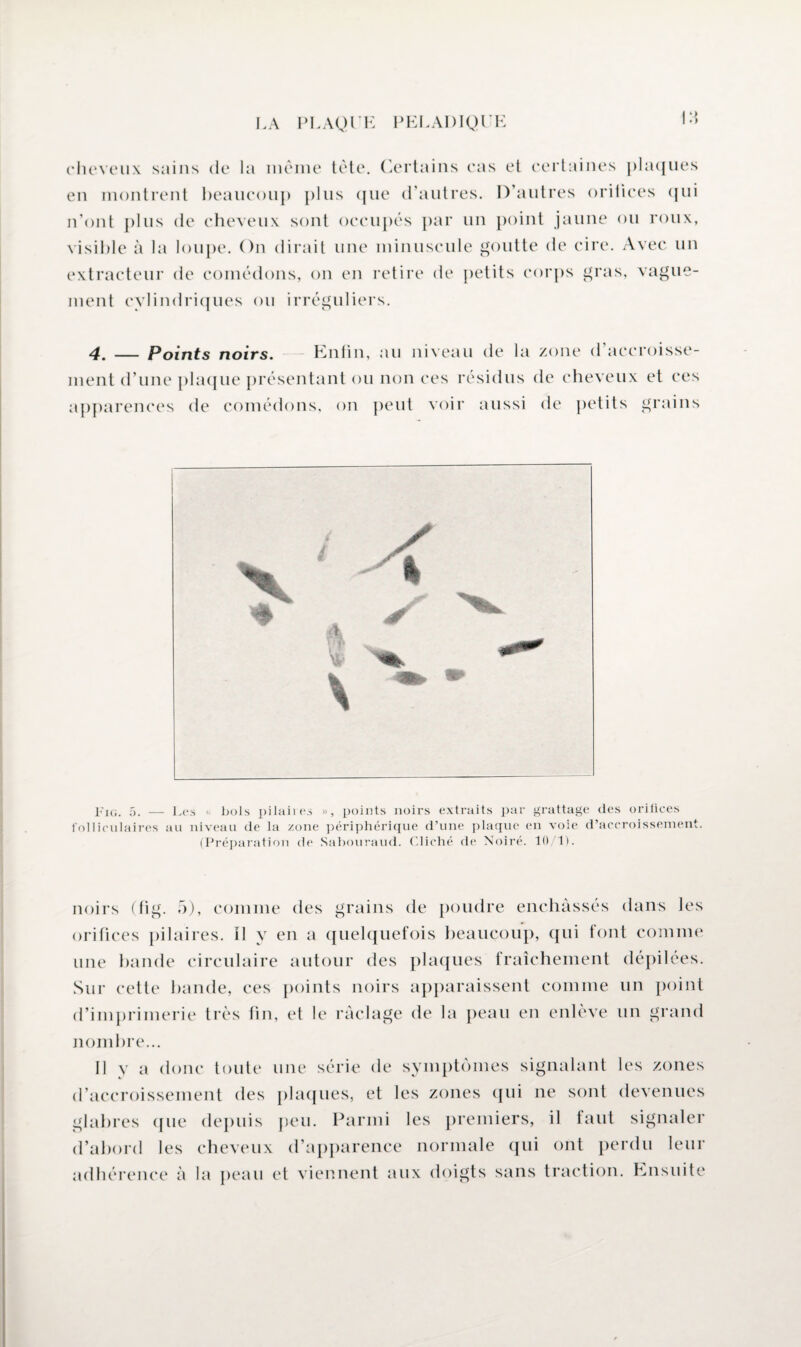 *> cheveux sains de la même tète. Certains cas et certaines plaques en montrent beaucoup plus que d’autres. D’autres orifices qui n’ont plus de cheveux sont occupés par un point jaune ou roux, visible à la loupe. On dirait une minuscule goutte de cire. Avec un extracteur de comédons, on en retire de petits corps gras, vague¬ ment cylindriques ou irréguliers. 4. — Points noirs. Enfin, au niveau de la zone d'accroisse¬ ment d’une plaque présentant ou non ces résidus de cheveux et ces apparences de comédons, on peut voir aussi de petits grains Fig. 5. — Les <• bols pilaires », points noirs extraits par grattage des orifices folliculaires au niveau de la zone périphérique d’une plaque en voie d’accroissement. (Préparation de Sabouraud. Cliché de Noire. 10 1). noirs (fig. 5), comme des grains de poudre enchâssés dans les orifices pilaires. Il y en a quelquefois beaucoup, qui font comme une bande circulaire autour des plaques fraîchement dépilées. Sur cette bande, ces points noirs apparaissent comme un point d’imprimerie très fin, et le raclage de la peau en enlève un grand nombre... Il y a donc toute une série de symptômes signalant les zones d’accroissement des plaques, et les zones qui ne sont devenues glabres que depuis peu. Parmi les premiers, il faut signaler d’abord les cheveux d’apparence normale qui ont perdu leur adhérence à la peau et viennent aux doigts sans traction. Ensuite
